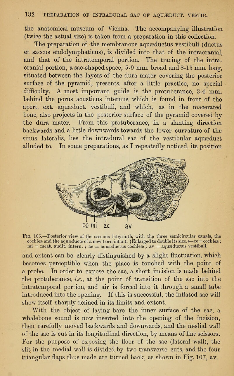 the anatomical museum of Vienna. The accompanying illustration (twice the actual size) is taken from a preparation in this collection. The preparation of the membranous aquseductus vestibuli (ductus et saccus endolymphaticus), is divided into that of the intracranial, and that of the intratemporal portion. The tracing of the intra- cranial portion, a sac-shaped space, 5-9 mm. broad and 8-15 mm. long, situated between the layers of the dura mater covering the posterior surface of the pyramid, presents, after a little practice, no special difficulty. A most important guide is the protuberance, 3-4 mm. behind the porus acusticus internus, which is found in front of the apert. ext. aquseduct. vestibuli, and which, as in the macerated bone, also projects in the posterior surface of the pyramid covered by the dura mater. From this protuberance, in a slanting direction backwards and a little downwards towards the lower curvature of the sinus lateralis, lies the intradural sac of the vestibular aquseduct alluded to. In some preparations, as I repeatedly noticed, its position CO mi Fig. 106.—Posterior view of the osseous labyrinth, with the three semicircular canals, the cochlea and the aquseducts of a new-born infant. (Enlarged to double its size.)—co = cochlea; mi — meat, audit, intern. ; ac = aquffiductus cochleae ; av = aquseductus vestibuli. and extent can be clearly distinguished by a slight fluctuation, which becomes perceptible when the place is touched with the point of a probe. In order to expose the sac, a short incision is made behind the protuberance, i.e., at the point of transition of the sac into the intratemporal portion, and air is forced into it through a small tube introduced into the opening. If this is successful, the inflated sac will show itself sharply defined in its limits and extent. With the object of laying bare the inner surface of the sac, a whalebone sound is now inserted into the opening of the incision, then carefully moved backwards and downwards, and the medial wall of the sac is cut in its longitudinal direction, by means of fine scissors. For the purpose of exposing the floor of the sac (lateral wall), the slit in the medial wall is divided by two transverse cuts, and the four triangular flaps thus made are turned back, as shown in Fig. 107, av.