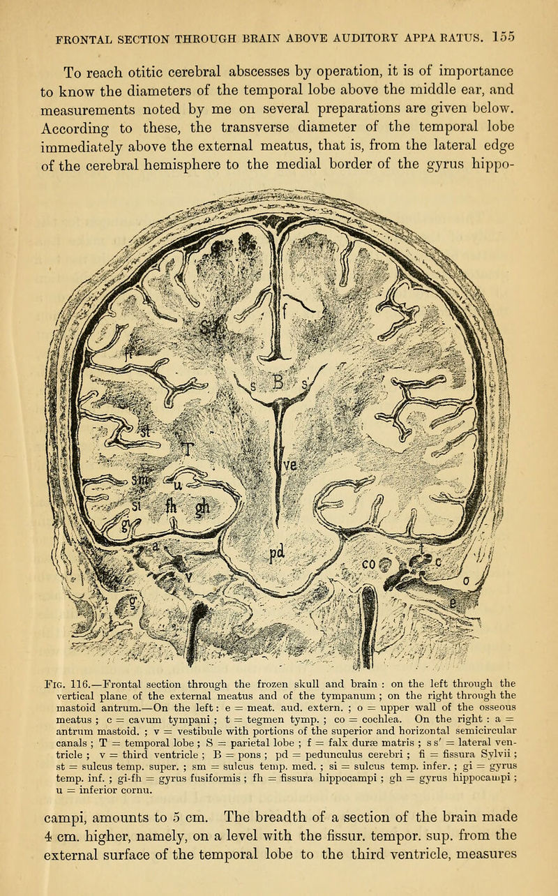 To reach otitic cerebral abscesses by operation, it is of importance to know the diameters of the temporal lobe above the middle ear, and measurements noted by me on several preparations are given below. According to these, the transverse diameter of the temporal lobe immediately above the external meatus, that is, from the lateral edge of the cerebral hemisphere to the medial border of the gyrus hippo- Fig. 116.—Frontal section through the frozen skull and brain : on the left through the vertical plane of the external meatus and of the tympanum ; on the right through the mastoid antrum.—On the left: e = meat. aud. extern. ; o = upper wall of the osseous meatus ; c = cavum tympani ; t = tegmen tymp. ; co = cochlea. On the right : a = antrum mastoid. ; v = vestibule with portions of the superior and horizontal semicircular canals ; T = temporal lobe ; S = parietal lobe ; f = falx durte matris ; s s' = lateral ven- tricle ; V = third ventricle ; B = pons ; pd = pedunciilus cerebri ; fi = fissura Sylvii ; st = sulcus temp, super. ; sm = sulcus temp. med. ; si = sulcus temp, infer. ; gi = gyrus temp. inf. ; gi-fh = gyrus fusiformis ; fh = fissura hippocampi ; gh =: gyrus hippocampi; u = inferior cornu. campi, amounts to 5 cm. The breadth of a section of the brain made 4 cm. higher, namely, on a level with the fissur. temper, sup. from the external surface of the temporal lobe to the third ventricle, measures