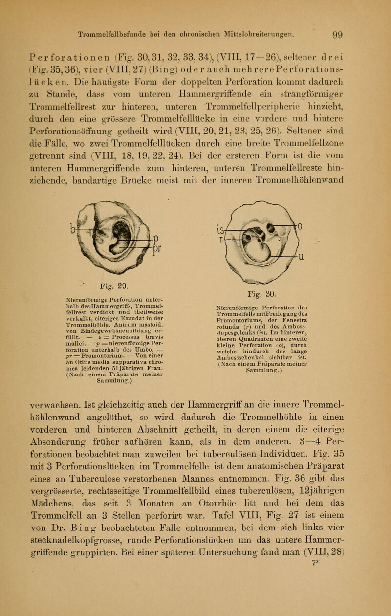 Perforationen (Fig. 30.31, 32, 33, 34), (VIII, 17-26), seltener drei (Fig.35, 36), vier (VIII, 27) (Bing) oder auch niehrerePerforations- 1 ü c k e n. Die häufigste Form der doppelten Perforation kommt dadurch zu Stande, dass vom unteren Hammergrififende ein strangförmiger Trommelfellrest zur hinteren, unteren Trommelfellperipherie hinzieht, durch den eine grössere Trommelfelllücke in eine vordere und hintere Perforationsöffnung getheilt wird (VIII, 20, 21, 23, 25, 26). Seltener sind die Fälle, wo zwei Trommelfelllttcken durch eine breite Tromraelfellzone getrennt sind (VIII, 18, 19. 22. 24). Bei der ersteren Form ist die vom unteren Hammergriffende zum hinteren, unteren Trommelfellreste hin- ziehende, bandartige Brücke meist mit der inneren Trommelhöhlenwand Fig. 29. Nierenförmige Perforation unter- halb desHammergiifts, Trommel- fellrest verdickt xmd tbeilweise verkalkt, eiteriges Exsudat in der Trommelhölile. Antrum mastoid. von Bindegewebsneubildung er- füllt. — i = Processus brevis mallei. — p =^ nierenförmige Per- foration unterhalb des ümbo. — pr = Promontorium. — Von einer an Otitis media suppurativa chro- nica leidenden 51jährigen Frau. (Xach einem Präparate meiner Sammlung.) Fig. 30. Nierenförmige Perforation des Trommelfells milFreileguBg des Promontoriums, der Fenestra rotunda (r) und des Amboss- stapesgelenks (is). Im hinteren, oberen Quadranten eine zweite kleine Perforation (o), durch welche hindurch der lange Ambossschenkel sichtbar ist. (Nach einem Präparate meiner Sammlung.) verwachsen. Ist gleichzeitig auch der Hammergriff an die innere Trommel- höhlenwand angelöthet, so wird dadurch die Trommelhöhle in einen vorderen und hinteren Abschnitt getheilt, in deren einem die eiterige Absonderung früher aufhören kann, als in dem anderen. 3—4 Per- forationen beobachtet man zuweilen bei tuberculösen Individuen. Fig. 35 mit 3 Perforationslücken im Trommelfelle ist dem anatomischen Präparat eines an Tuberculose verstorbenen Mannes entnommen. Fig. 36 gibt das vergrösserte, rechtsseitige Trommelfellbild eines tuberculösen, 12jährigen Mädchens, das seit 3 Monaten an Otorrhöe litt und bei dem das Trommelfell an 3 Stellen perforii-t war. Tafel VIII, Fig. 27 ist einem von Dr. Bing beobachteten Falle entnommen, bei dem sich links vier stecknadelkopfgrosse, runde Perforationslücken um das untere Hammer- griffende gruppirten. Bei einer späteren Untersuchung fand man (VIII, 28j