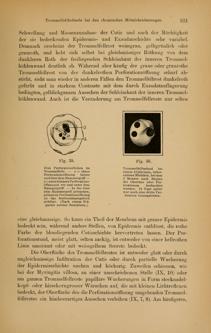 Schwellunji' und Massenzunahuie der Cutis und nach dw Mächtig-keit der sie bedeckenden Epidermis- und Exsudatschiclite sehr variabel. Demnach erscheint der TrommelfeUrest weissgrau, gelbgrünlich oder grauroth, und hebt sich selbst bei gleichmässiger Röthung von dem dunkleren Roth der freiliegenden Schleimhaut der inneren Trommel- höhlenwand deutlich ab. Während aber häutig der graue oder graurothe Trommelfellrest von der dunkelrothen Perforationsüffnung scharf ab- sticht, sieht man wieder in anderen Fällen den Trommelfellrest dunkelroth gefärbt und in starkem Contraste mit dem durch Exsudatauflagerung bedingten, gelblichgrauen x4.ussehen der Schleimhaut der inneren Trommel- höhlenwand. Auch ist die Veränderung am Trommelfellreste nur selten Fig. 35. Drei Perforationslücken im Trommelfelle. — o ^ obere Perforationsöfifiiuiig hinter undüberdem Hammergriff.— u—zwei kleinere Perforations- öflfnuiig'en vor und unter dem Hammergriff. — In der über dem Hammergriff gelegenen, grösseren Perforationsöffnung ist das Ambossstapesgelenk sichtbar. (Nach einem Prä- parate meiner Sammlung.) Fig. 36. Trommelfellbefund bei einem 12jährigen, tuber- culösen Mädchen, bei dem 3 Monate nach Beginn der Otorrhoe zwei Per- forationen beobachtet wurden. 14 Tage später war noch eine dritte Per- foration hinzugetreten. eine gieichmässige. So kann ein Theil der Membran mit grauer Epidermis bedeckt sein, während andere Stellen, von Epidermis entblösst, die rothe Farbe der blossHegenden Cutisschichte hervortreten lassen. Der Per- forationsrand, meist glatt, selten zackig, ist entweder von einer hellrothen Linie umsäumt oder mit weissgelbem Secrete bedeckt. Die Oberfläche des Trommelfellrestes ist entweder glatt oder durch ungleichmässige Infiltration der Cutis oder durch partielle Wucherung der Epidermisschichte uneben und höckerig. Zuweilen schiessen, wie bei der Myringitis villosa, an einer umschriebenen Stelle (IX, 10) oder am ganzen Trommelfellreste papilläre Wucherungen in Form Stecknadel- kopf- oder hirsekorngrosser Wärzchen auf, die mit kleinen Lichtreflexen bedeckt, der Oberfläche des die Perforationsöfiiiung umgebenden Trommel- fellrestes ein himbeerartiges Aussehen verleihen (IX, 7, 8). Am häufigsten,
