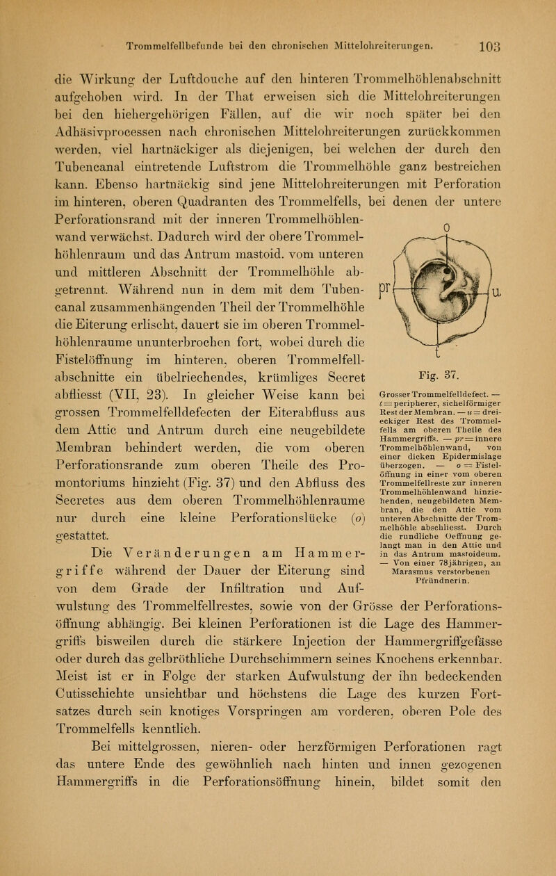 die Wirkung: der Luftdouche auf den hinteren Tromnielhühlenal)Sclinitt aufgehoben wird. In der That erAveisen sich die Mittelohreiterungen bei den hiehergehörigen Fällen, auf die Avir noch später bei den Adhäsivprocessen nach chronischen Mittelohreiterungen zurückkommen werden, viel hartnäckiger als diejenigen, bei welchen der durch den Tubencanal eintretende Luftstrom die Trommelhöhle ganz bestreichen kann. Ebenso hartnäckig sind jene Mittelohreiterungen mit Perforation im hinteren, oberen Quadranten des Trommelfells, bei denen der untere Perforationsrand mit der inneren Trommelhöhlen- wand verwächst. Dadurch wird der obere Trommel- höhlenraum und das Antrum mastoid. vom unteren und mittleren Abschnitt der Trommelhöhle ab- getrennt. Während nun in dem mit dem Tuben- canal zusammenhängenden Theil der Trommelhöhle die Eiterung erlischt, dauert sie im oberen Trommel- höhlenraume ununterbrochen fort, wobei durch die Fistelöffnung im hinteren, oberen Trommelfell- abschnitte ein übelriechendes, krümliges Secret Fig. 37. abfliesst (YII, 23). In gleicher Weise kann bei GrosserTrommeifeiidefect.— _ i! = peripherer, sichelförmiger .2:rOSSen Trommelfelldefecten der EiterabfluSS aus Rest der Membran.—«= drei- eckiger Rest des Trommel- fells am oberen Theile des Hammergriffs. —p?-^ innere Trommelhöhlenwand, von einer dicken Epidermislage überzogen. — o = Fistel- öffnung in einer vom oberen Trommelfellresle zur inneren n 1 1 Trommelhöhlenwand hinzie- öecretes aus dem oberen Trommelhöhlenraume henden, neugebiideten Mem- • 1 1 bran, die den Attic vom nur durch eine kleine Periorationslücke (o) dem Attic und Antrum durch eine neugebildete Membran behindert werden, die vom oberen Perforationsrande zum oberen Theile des Pro- montoriums hinzieht (Fig. 37) und den Abfluss des unteren Abschnitte der Trom- melhöhle abschliesst. Durch die rundliche Oeffnung ge- langt man in den Attic und in das Antrum mastoideum. — Von einer 78jährigen, an Marasmus verstorbenen Pfründnerin. gestattet. Die Veränderungen am Hammer- griffe während der Dauer der Eiterung sind von dem Grade der Infiltration und Auf- wulstung des Trommelfellrestes, sowie von der Grösse der Perforations- öffnung abhängig. Bei kleinen Perforationen ist die Lage des Hammer- griffs bisweilen durch die stärkere Injection der Hammergriffgefässe oder durch das gelbröthliche Durchschimmern seines Knochens erkennbar. Meist ist er in Folge der starken Aufwulstung der ihn bedeckenden Cutisschichte unsichtbar und höchstens die Lage des kurzen Fort- satzes durch sein knotiges Vorspringen am vorderen, oberen Pole des Trommelfells kenntlich. Bei mittelgrossen, nieren- oder herzförmigen Perforationen ragt das untere Ende des gewöhnlich nach hinten und innen gezogenen Hammergriffs in die Perforationsöffnung hinein, bildet somit den