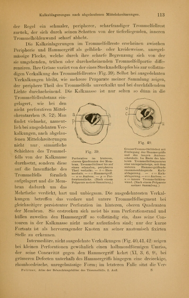 der Rei>el ein schmaler, peripherer, scharf randiger Tromnielfenrest zurück, der sich durch seinen Schatten von der tietcrliegenden, inneren Trommelhöhlen wand scharf abhelft. Die Kalkeinlagerunoen im Trommelfellreste erscheinen zwischen Peripherie und Hammergriff als gelblich- oder kreide weisse, unregel- mässige Flecke. Avelche durch ihre scharfe Begrenzung sich von der sie umoebenden, trüben oder durchscheinenden Trommelfellpartie diffe- renziren. Ihre Grösse variirt von der eines Stecknadelkopfes bis zur vollstän- digen Verkalkung des Trommelfellrestes (Fig. 39). Selbst bei ausgedehnten Verkalkungen bleibt. Avie mehrere Präparate meiner Sammlung zeigen, der periphere Theil des Trommelfells unverkalkt und bei durchfallendem Lichte durchscheinend. Die Kalkmassc ist nur selten so dünn in die Trommelfellsubstanz ein- gelagert, wie bei den nicht perforativen Mittel- ohrcatarrhen (S. 72). Man findet vielmehr, nament- lich bei ausgedehnten Ver- kalkungen, nach abgelau- fenen Mittelohreiterungen nicht nur . sämmtliche Schichten des Trommel- fells von der Kalkmasse durchsetzt, sondern diese auf die Innenfläche des Trommelfells förmlich aufgelagert und die Mem- bran dadurch um das Mehrfache verdickt, hart und unbiegsam. Die ausgedehntesten Verkal- kungen betreffen das vordere und untere Trommelfellsegment bei gleichzeitiger persistenter Perforation im hinteren, oberen Quadranten der Membran. Sie erstrecken sich meist bis zum Perforationsrand und hüllen zuweilen den Hammergriff so vollständig ein. dass seine Con- touren in der Kalkmasse nicht mehr aufzufinden sind; nur der kurze Fortsatz ist als hervorragender Knoten an seiner anatomisch fixirten Stelle zu erkennen. Intermediäre, nicht ausgedehnte Verkalkungen (Fig. 40,41.421 zeigen bei kleinen Perforationen gewöhnlich einen halbmondförmigen Umriss, der seine Concavität gegen den Hammergriff kehrt (XI, 3. 6. 9). bei grösseren Defecten unterhalb des Hammergriffs hingegen eine dreieckige, rhomboedrische. unregelmässige Form; im letzteren Falle sitzt die Ver- Politzer, Atlas der Beleiichtungsbilder des Trommelfells. 2. Aufl. 8 Fig. 39. Perforation im hinteren, oberen Quadranten der Mem- bran. Trommelteilrest bis auf einen schmalen, peripheren Theil verkalkt. — 7^= Ham- merhais. — i'=-Hammergriff. — a = Amboss. — P = Per- forationslücke. (Nach einem Präparate meiner Sammlung.) Fig. 40. CTrosserTrommclfelldefect mit Freilegung des Hammergrifis und des langen Araboss- pchenkels. Im Reste des hin- teren Trommelfellsegmentes eine unregelmässige, mit dem unteren Hammergriffende zusammenhängende Kalk- ablagerung. — c = ICalk- ablagerung. — o = Amboss. — u = innere Trommelhöhlen- wand. (Nach einem Präparate meiner Sammlung.)