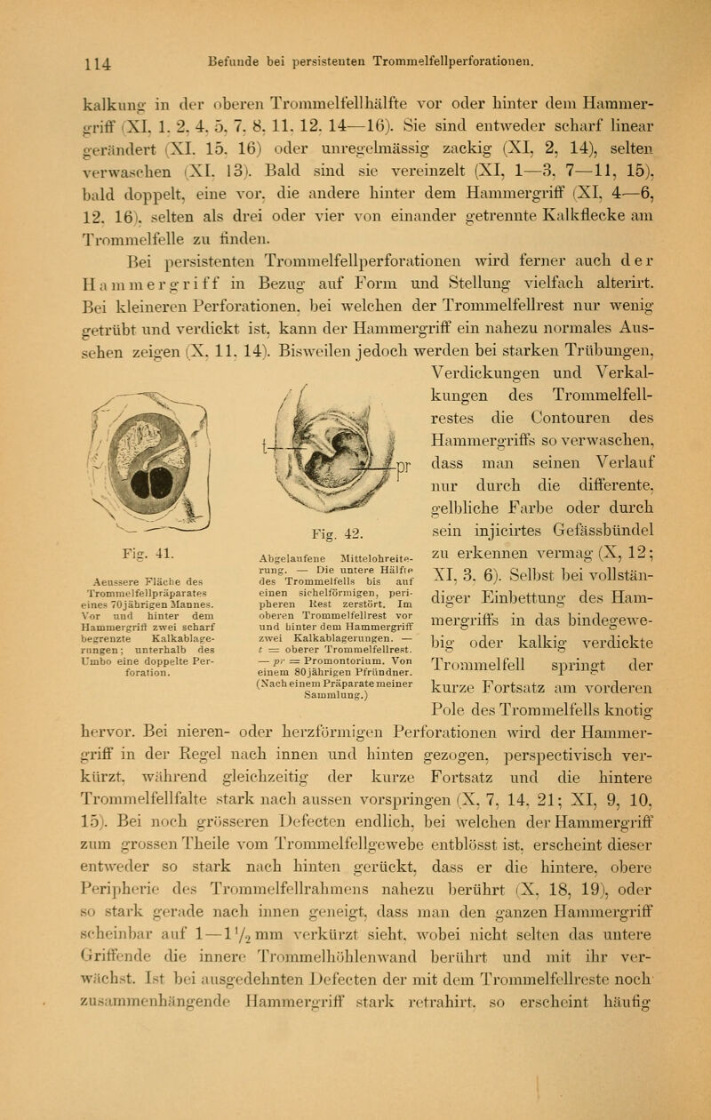 kalkung' in der oberen Trommelfellhälfte vor oder hinter dem Haramer- g-riff (XI. 1. 2. 4. 5, 7. 8, 11. 12. 14—16). Sie sind entweder scharf linear gerändert (XL 15. 16) oder unregelmässig zackig (XI, 2, 14), selten verwaschen (XI. 13). Bald sind sie vereinzelt (XI, 1—3, 7—11, 15), bald doppelt, eine vor. die andere hinter dem Hammergriff (XI, 4—6, 12. 16). selten als drei oder vier von einander getrennte Kalkflecke am Trommelfelle zu finden. Bei persistenten Trommelfellperforationen wird ferner auch d e r H a m m e r g r i f f in Bezug auf Form und Stellung vielfach alterirt. Bei kleineren Perforationen, bei welchen der Trommelfellrest nur wenig getrübt und verdickt ist, kann der Hammergriff ein nahezu normales Aus- sehen zeigen (X. 11. 14). Bisweilen jedoch werden bei starken Trübungen, Verdickungen und Verkal- T-^. Fig. 42. Fig. 41. Aeussere Fläche des Tromraelfellpräparates eines 70jährigen Mannes. Vor und hinter dem Hammergritt zwei scharf begrenzte Kalkablage- rungen ; unterhalb des Umbo eine doppelte Per- foration. kungen des Trommelfell- restes die Contouren des Hammergriffs so verwaschen, dass man seinen Verlauf nur durch die differente, gelljhche Farbe oder durch sein injicirtes Gefässbündel zu erkennen vermag (X, 12; XI, 3. 6). Selbst bei vollstän- diger Einbettung des Ham- mergriffs in das bindeorewe- big oder kalkig verdickte Tr(jmmelfell springt der kurze Fortsatz am vorderen Pole des Trommelfells knotig hervor. Bei nieren- oder herzfürmigen Perforationen wird der Hammer- griff in dei- Regel nach innen und hinten gezogen, perspectivisch ver- kürzt, während gleichzeitig der kurze Fortsatz und die hintere Trommelfellfalte stark nach aussen vorspringen (X, 7, 14, 21; XI, 9, 10, 15). Bei noch grösseren Defecten endlich, bei welchen der Hammergriff' zum grossen Theile vom Trommelfellgewebe entblösst ist, erscheint dieser entweder so stark nach hinten gerückt, dass er die hintere, obere Peripherie des Trommelfellrahmens nahezu berührt (X, 18, 19), oder so stark gerade nach innen geneigt, dass man den ganzen Hammergriff scheinbar auf 1 — l'^mm verkürzt sieht, wobei nicht selten das untere Griffende die innere TrommelhühlenAvand berührt und init ihr ver- wächst. Ist bei ausgedehnten Defecten der mit dem Trommelfellrestc noch zusammenhängende Hammergriff stark retrahirt, so erscheint häufig Abgelaufene llittelohreite- rung. — Die untere Hälfie des Trommelfells bis auf einen sichelförmigen, peri- pheren Rest zerstört. Im oberen Trommelfellrest vor und hinter dem Hammergriff zwei Kalkablagerungen. — t = oberer Tronimelfellrest. — pr = Promontorium. Von einem 80jährigen Pfründner. (Xach einem Präparate meiner Sammlung.)