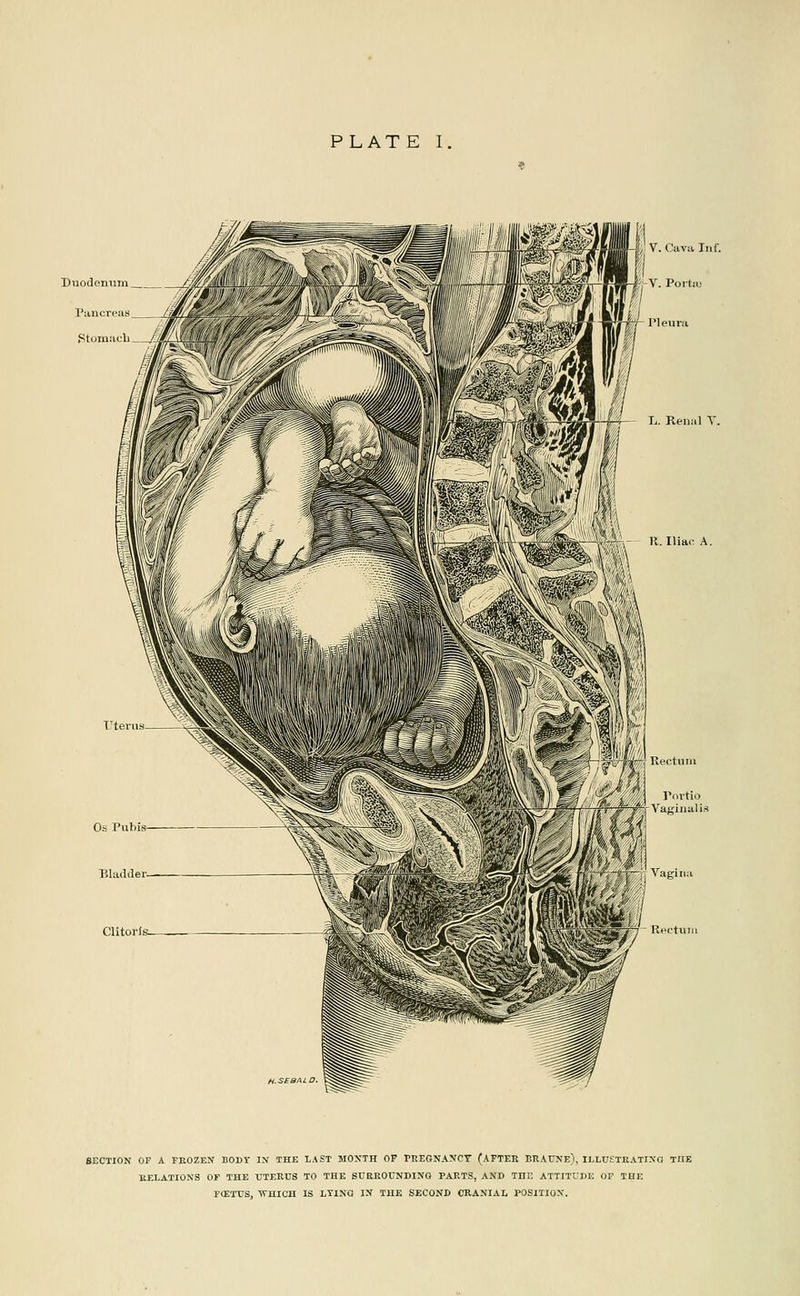 Chtoi fs_ BECTION or A FROZEN BODY IN THE LAST MOXTH OF PltEGNANCT (AFTER BIlAnNE), ILLUETKATING THE EELATIONS OF THE UTERDS TO THE SUREOUNDINQ PARTS, AKD THE ATTITUDE OP THE FtElTS, ■WHICH IS LTINQ IN THE SECOND CRANIAL POSITION.