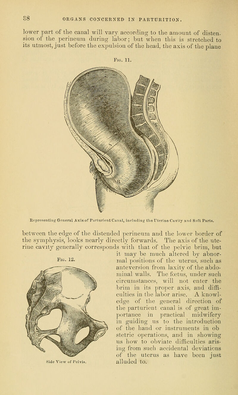 88 lower part of the canal will vary according to the amount of disten- sion of the perineum during labor; but when this is stretched to its utmost, just before the expulsion of the head, the axis of the plane Fig. 11. Representing General Axis of Parturient Canal, inclnding tlie Uterine Cavity and Soft Parts. Fig. 12. between the edge of the distended perineum and the lower border of the symphysis, looks nearly directly forwards. The axis of the ute- rine cavity generally corresponds with that of the pelvic brim, but it may be much altered by abnor- mal positions of the uterus, such as anteversion from laxity of the abdo- minal walls. The foetus, under such circumstances, will not enter the brim in its proper axis, and diffi- culties in the labor arise. A knoAvl- edge of the general direction of the parturient canal is of great im- portance in practical midwifery in guiding us to the introduction of the hand or instruments in ob stetric operations, and in showing us how to obviate difficulties aris- ing from such accidental deviations of the uterus as have been just Side View of Pelvis. alludcd tO.