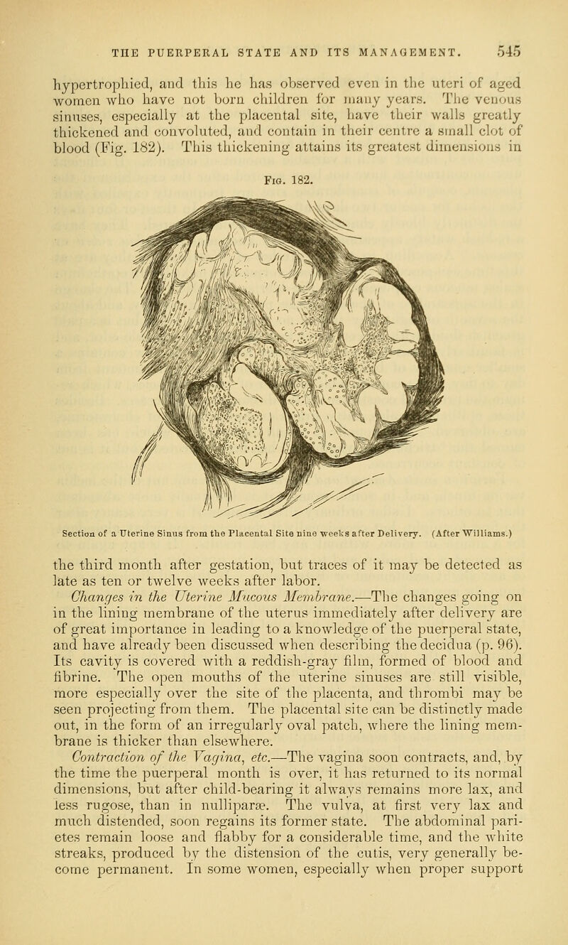 hypertropliied, and tliis he has observed even in the uteri of aged women who have not born children for many years. The venous sinuses, especially at the placental site, have their walls greatly thickened and convoluted, and contain in their centre a small clot of blood (Fig. 182). This thickening attains its greatest dimensions in Fig. 182. Section of a Uterine Sinus from the Placental Site nine weeks after Delivery. (After Williams.) the third month after gestation, but traces of it may be detected as late as ten or twelve weeks after labor. Changes in the Uterine Mucous Membrane.—The changes going on in the lining membrane of the uterus immediately after delivery are of great importance in leading to a knowledge of the puerperal state, and have already been discussed when describing thedecidua (p. 96). Its cavity is covered with a reddish-gray film, formed of blood and fibrine. The open mouths of the uterine sinuses are still visible, more especially over the site of the placenta, and thrombi may be seen projecting from them. The placental site can be distinctly made out, in the form of an irregularly oval patch, where the lining mem- brane is thicker than elsewhere. Contraction of the Vagina., etc.—The vagina soon contracts, and, by the time the puerperal month is over, it has returned to its normal dimensions, but after child-bearing it always remains more lax, and less rugose, than in nulliparae. The vulva, at first very lax and much distended, soon regains its former state. The abdominal pari- etes remain loose and flabby for a considerable time, and the white streaks, produced by the distension of the cutis, very generally be- come permanent. In some women, especially when proper support