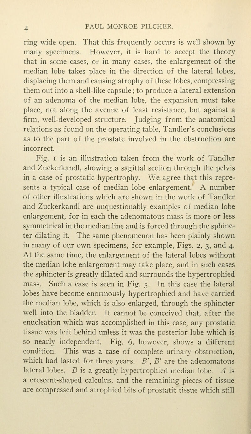 ring wide open. That this frequently occurs is well shown by many specimens. However, it is hard to accept the theory that in some cases, or in many cases, the enlargement of the median lobe takes place in the direction of the lateral lobes, displacing them and causing atrophy of these lobes, compressing them out into a shell-like capsule; to produce a lateral extension of an adenoma of the median lobe, the expansion must take place, not along the avenue of least resistance, but against a firm, well-developed structure. Judging from the anatomical relations as found on the operating table, Tandler's conclusions as to the part of the prostate involved in the obstruction are incorrect. Fig. I is an illustration taken from the work of Tandler and Zuckerkandl, showing a sagittal section through the pelvis in a case of prostatic hypertrophy. We agree that this repre- sents a typical case of median lobe enlargement.' A number of other illustrations which are shown in the work of Tandler and Zuckerkandl are unquestionably examples of median lobe enlargement, for in each the adenomatous mass is more or less symmetrical in the median line and is forced through the sphinc- ter dilating it. The same phenomenon has been plainly shown in many of our own specimens, for example, Figs. 2, 3, and 4, At the same time, the enlargement of the lateral lobes without the median lobe enlargement may take place, and in such cases the sphincter is greatly dilated and surrounds the hypertrophied mass. Such a case is seen in Fig. 5. In this case the lateral lobes have become enormously hypertrophied and have carried the median lobe, which is also enlarged, through the sphincter well into the bladder. It cannot be conceived that, after the enucleation which was accomplished in this case, any prostatic tissue was left behind unless it was the posterior lobe which is so nearly independent. Fig. 6, however, shows a different condition. This was a case of complete urinary obstruction, which had lasted for three years. B', B' are the adenomatous lateral lobes. 5 is a greatly hypertrophied m^edian lobe. A is a crescent-shaped calculus, and the remaining pieces of tissue are compressed and atrophied bits of prostatic tissue which still