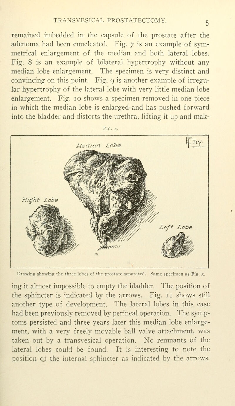 TRANSVESICAL PROSTATECTOMY. remained imbedded in the capsule of the prostate after the adenoma had been enucleated. Fig. 7 is an example of sym- metrical enlargement of the median and both lateral lobes. Fig. 8 is an example of bilateral hypertrophy without any median lobe enlargement. The specimen is very distinct and convincing on this point. Fig. 9 is another example of irregu- lar hypertrophy of the lateral lobe with very little median lobe enlargement. Fig. 10 shows a specimen removed in one piece in which the median lobe is enlarged and has pushed forward into the bladder and distorts the urethra, lifting it up and mak- FlG. 4. Median Lobe r^ Eight Lobe Drawing showing tlie three lobes of the prostate separated. Same specimen as Fig. 3. ing it almost impossible to empty the bladder. The position of the sphincter is indicated by the arrows. Fig. ii shows still another type of development. The lateral lobes in this case had been previously removed by perineal operation. The symp- toms persisted and three years later this median lobe enlarge- ment, with a very freely movable ball valve attachment, was taken out by a transvesical operation. No remnants of the lateral lobes could be found. It is interesting to note the position o_f the internal sphincter as indicated by the arrows.