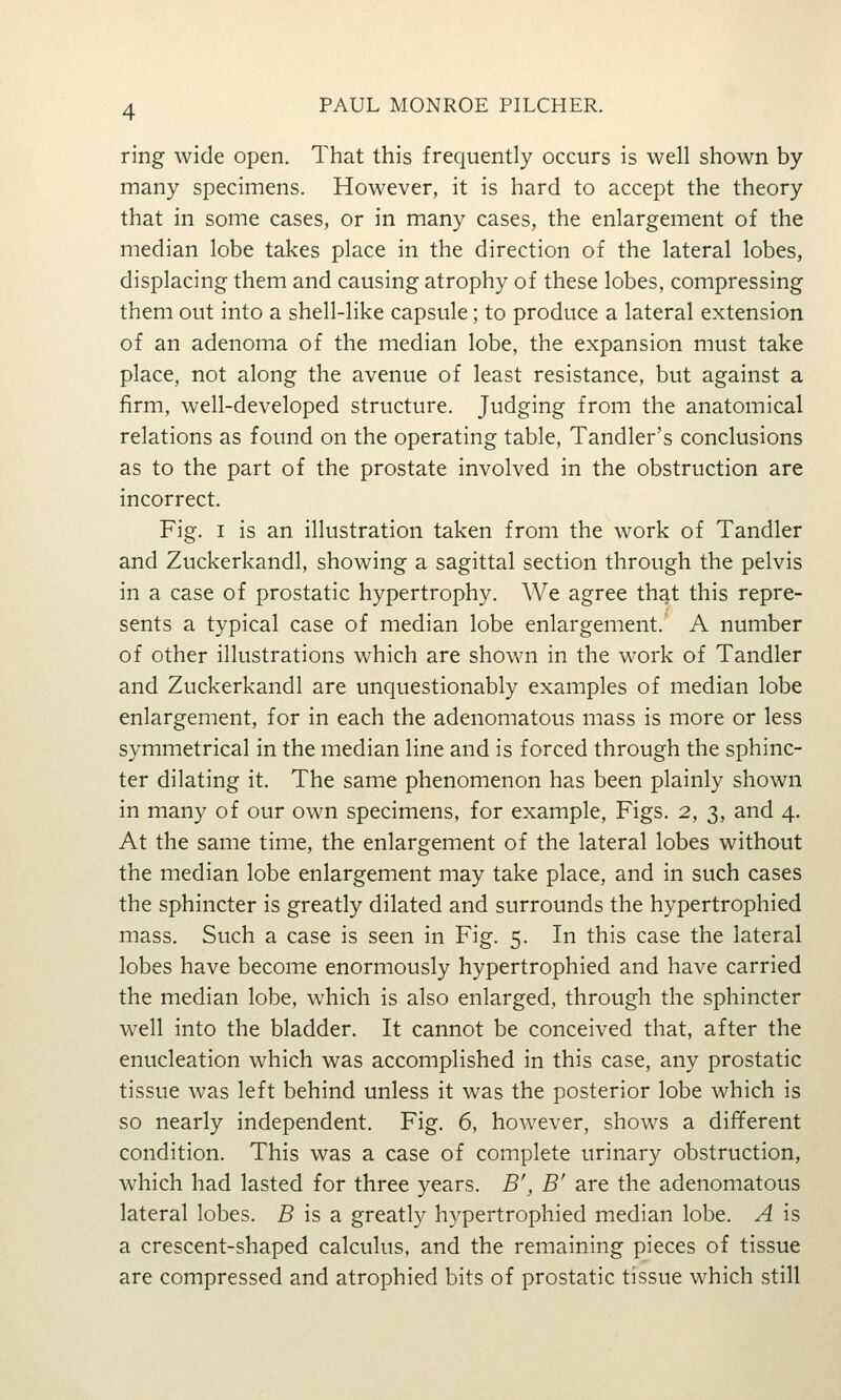 ring wide open. That this frequently occurs is well shown by many specimens. However, it is hard to accept the theory that in some cases, or in many cases, the enlargement of the median lobe takes place in the direction of the lateral lobes, displacing them and causing atrophy of these lobes, compressing them out into a shell-like capsule; to produce a lateral extension of an adenoma of the median lobe, the expansion must take place, not along the avenue of least resistance, but against a firm, well-developed structure. Judging from the anatomical relations as found on the operating table, Tandler's conclusions as to the part of the prostate involved in the obstruction are incorrect. Fig. I is an illustration taken from the work of Tandler and Zuckerkandl, showing a sagittal section through the pelvis in a case of prostatic hypertrophy. We agree that this repre- sents a typical case of median lobe enlargement. A number of other illustrations which are shown in the work of Tandler and Zuckerkandl are unquestionably examples of median lobe enlargement, for in each the adenomatous mass is more or less symmetrical in the median line and is forced through the sphinc- ter dilating it. The same phenomenon has been plainly shown in many of our own specimens, for example, Figs. 2, 3, and 4. At the same time, the enlargement of the lateral lobes without the median lobe enlargement may take place, and in such cases the sphincter is greatly dilated and surrounds the hypertrophied mass. Such a case is seen in Fig. 5. In this case the lateral lobes have become enormously hypertrophied and have carried the median lobe, which is also enlarged, through the sphincter well into the bladder. It cannot be conceived that, after the enucleation which was accomplished in this case, any prostatic tissue was left behind unless it was the posterior lobe which is so nearly independent. Fig. 6, however, shows a different condition. This was a case of complete urinary obstruction, which had lasted for three years. B', B' are the adenomatous lateral lobes. 5 is a greatly h3^pertrophied median lobe. A is a crescent-shaped calculus, and the remaining pieces of tissue are compressed and atrophied bits of prostatic tissue which still