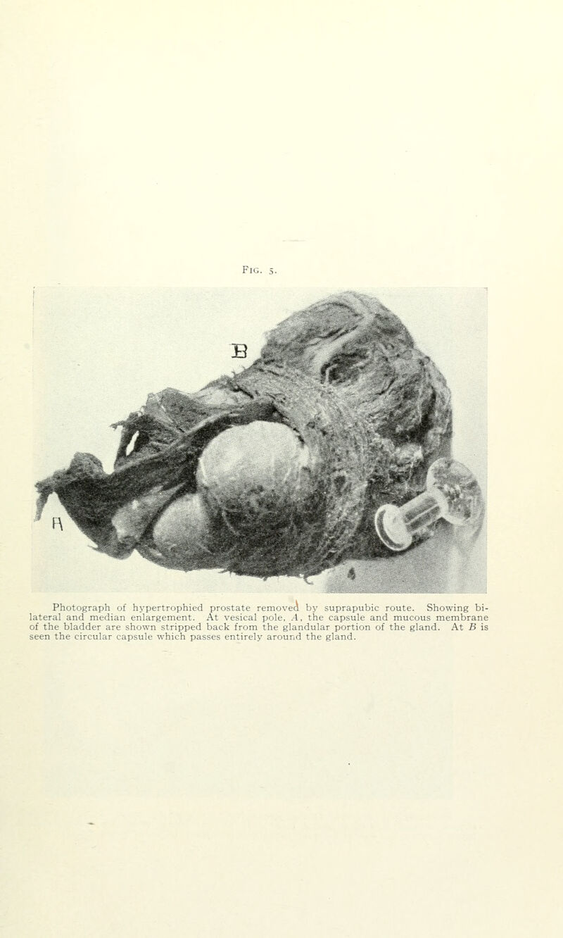 B .^ Photograph of hypertrophied prostate removed by suprapubic route. Showing bi- lateral and median enlargement. At vesical pole, .4, the capsule and mucous membrane of the bladder are shown stripped back from the glandular portion of the gland. At B is seen the circular capsule which passes entirely around the gland.