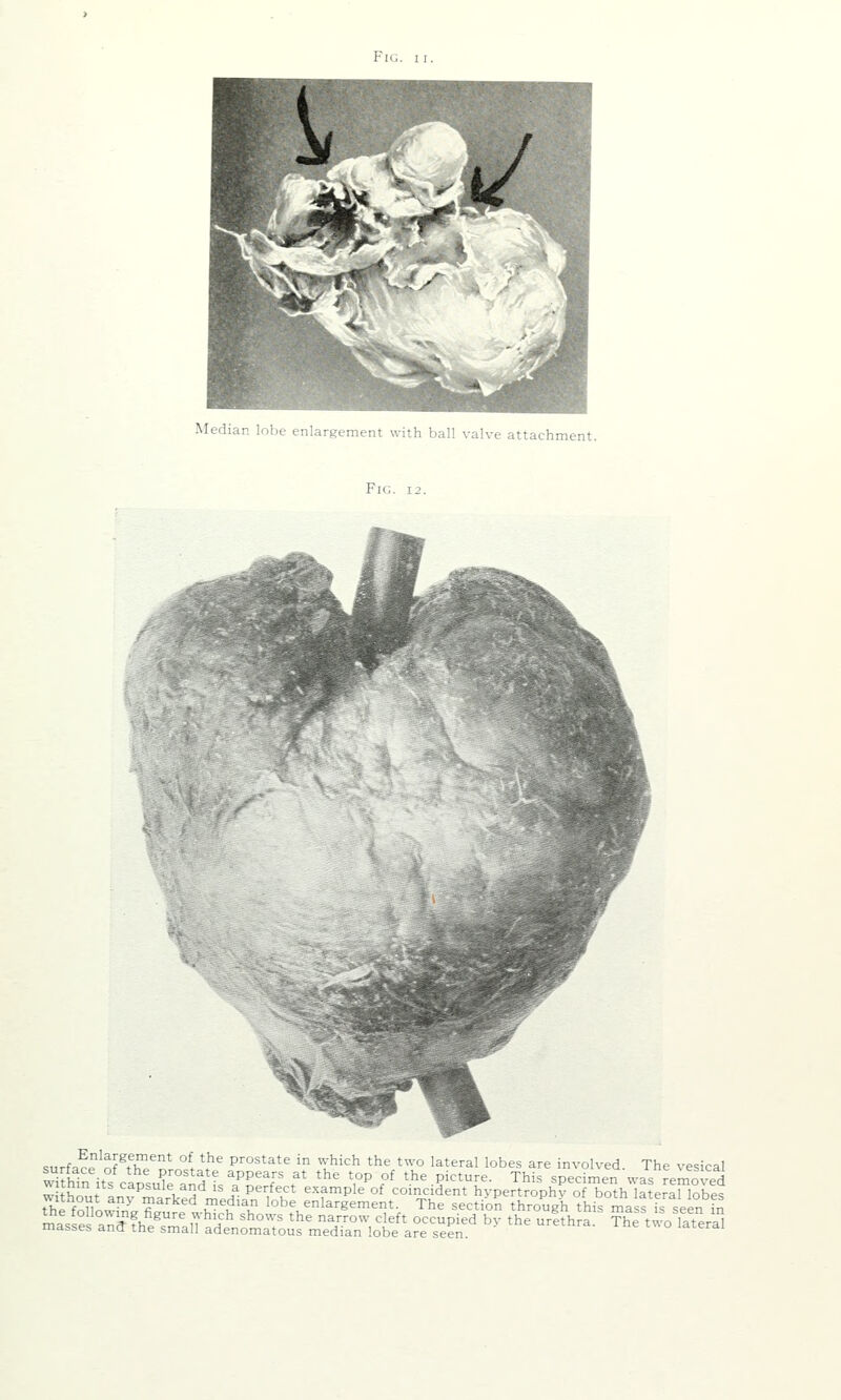 Median lobe enlargement with ball valve attachment. Fig. 12 <:„rfaor'^f^fi!!!'''^ °^ ^^^ prostate in which the two lateral lobes are involved The vesical within it/ol^ prostate appears at the top of the picture. This specimen was removed w thm Its capsule and is a perfect example of coincident hvpertrophy of both lateraUobes th^ fnnl''^ '^'''^^'^ ^^^'^ ^^'^ enlargement. The section through this mass fs seen in ^.i^ Iffv,^^'^ ,Yhich shows the narrow cleft occupied by the urithra The tvvo lateral masses and the small adenomatous median lobe are seen 'J ureinra. ine tv^o lateral