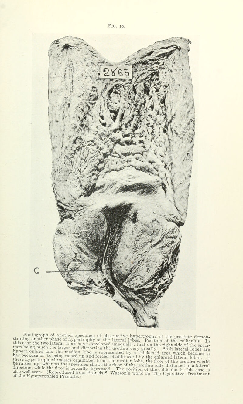 '^^^2 ' ■«--7fi'' ^'-*T'j»* ^-1 ■.■at ■ -'^ Photograph of another specimen of obstructive hypertrophy of the prostate demon- strating another phase of hypertrophy of the lateral lobes. Position of the colliculus. In this case the two lateral lobes have developed unequally, that on the right side of the speci- men being much the larger and distorting the urethra very greatly. Both lateral lobes are hypertrophied and the median lobe is represented by a thickened area which becomes a bar because of its being raised up and forced bladderward by the enlarged lateral lobes. If these hypertrophied masses originated from the median lobe, the floor of the urethra would be raised up, whereas the specimen shows the floor of the urethra only distorted in a lateral . In „ n ■ ^''^ % '^°°J '^ actually depressed. The position of the colliculus in this case is of\rHVp%VoS?d1?rost1te':r '■ ^''^ ^'^ ° '^ °P^^''^ Treatment