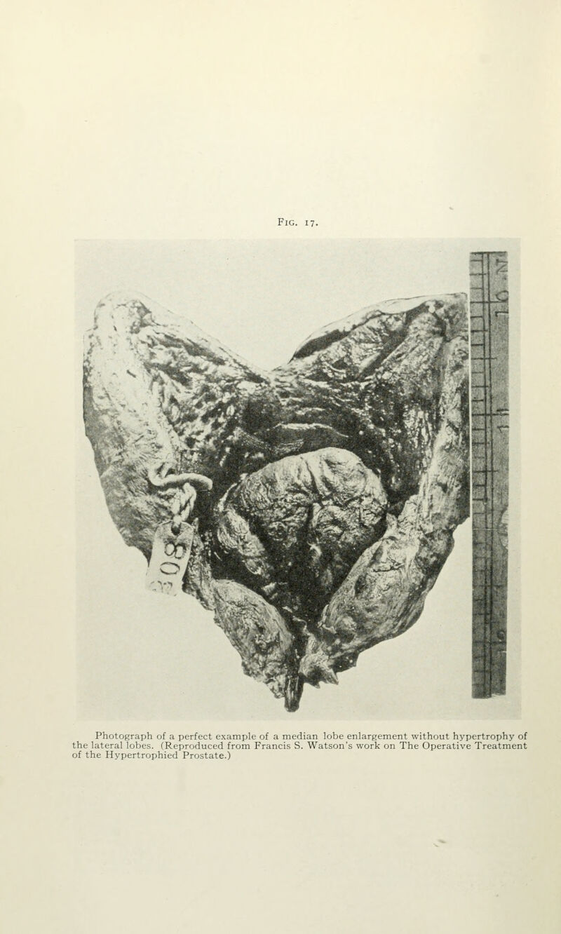 Photograph of a perfect example of a median lobe enlargement without hypertrophy of the lateral lobes. (Reproduced from Francis S. Watson's work on The Operative Treatment