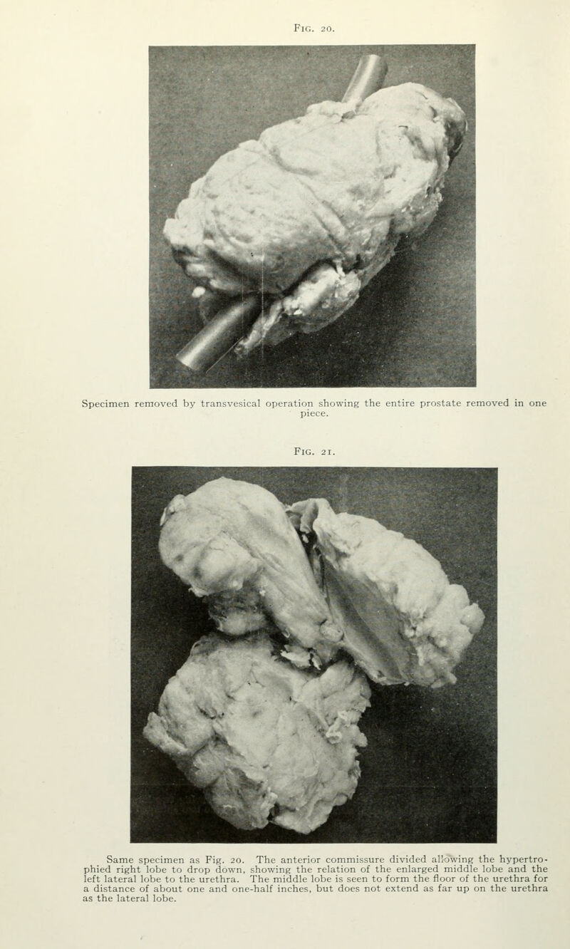 Specimen removed by transvesical operation showing the entire prostate removed in one piece. Fig. 21. Same specimen as Fig. 20. The anterior commissure divided allowing the hypertro- phied right lobe to drop down, showing the relation of the enlarged middle lobe and the left lateral lobe to the urethra. The middle lobe is seen to form the floor of the urethra for a distance of about one and one-half inches, but does not extend as far up on the urethra as the lateral lobe.