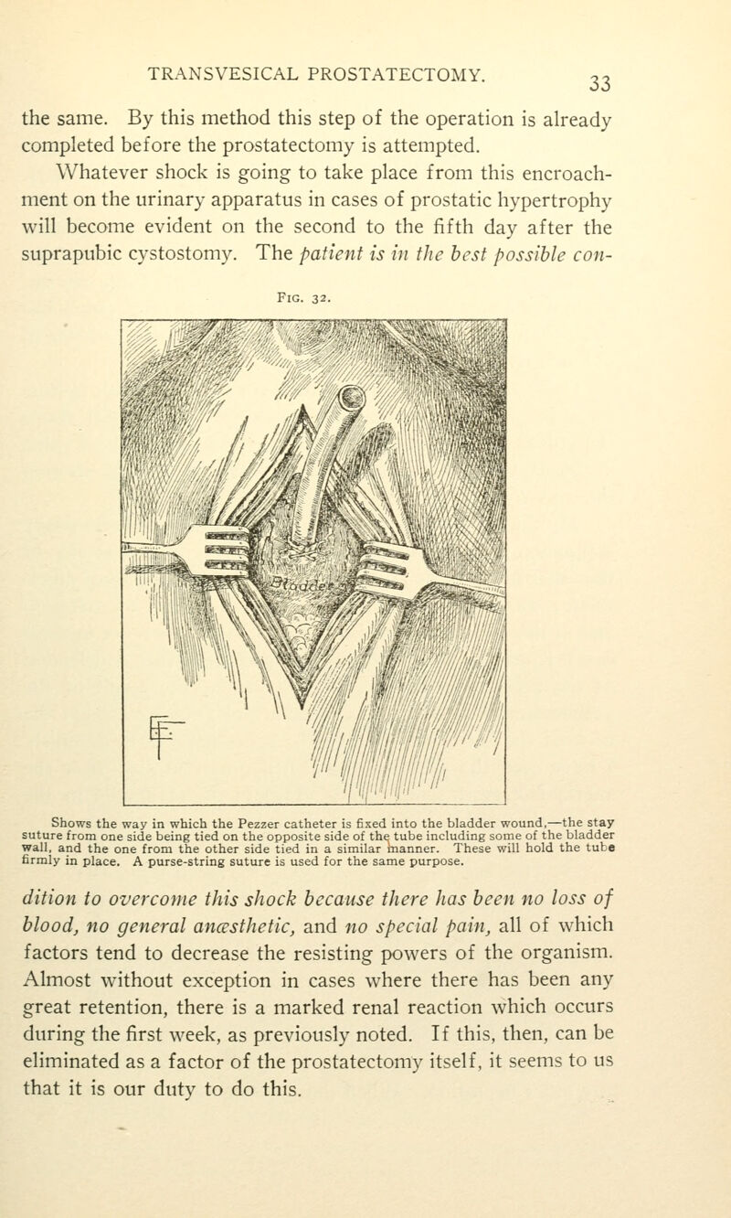 33 the same. By this method this step of the operation is already- completed before the prostatectomy is attempted. Whatever shock is going to take place from this encroach- ment on the urinary apparatus in cases of prostatic hypertrophy will become evident on the second to the fifth day after the suprapubic cystostomy. The patient is in the best possible con- FiG. 32. 'i^-^jm''f^'' -'W^P^'M Shows the way in which the Pezzer catheter is fixed into the bladder wound,—the stay suture from one side being tied on the opposite side of the tube including some of the bladder wall, and the one from the other side tied in a similar manner. These will hold the tube firmly in place. A purse-string suture is used for the same purpose. dition to overcome this shock because there has been no loss of blood, no general ancesthetic, and no special pain, all of which factors tend to decrease the resisting powers of the organism. Almost without exception in cases where there has been any great retention, there is a marked renal reaction which occurs during the first week, as previously noted. If this, then, can be eliminated as a factor of the prostatectomy itself, it seems to us that it is our duty to do this.
