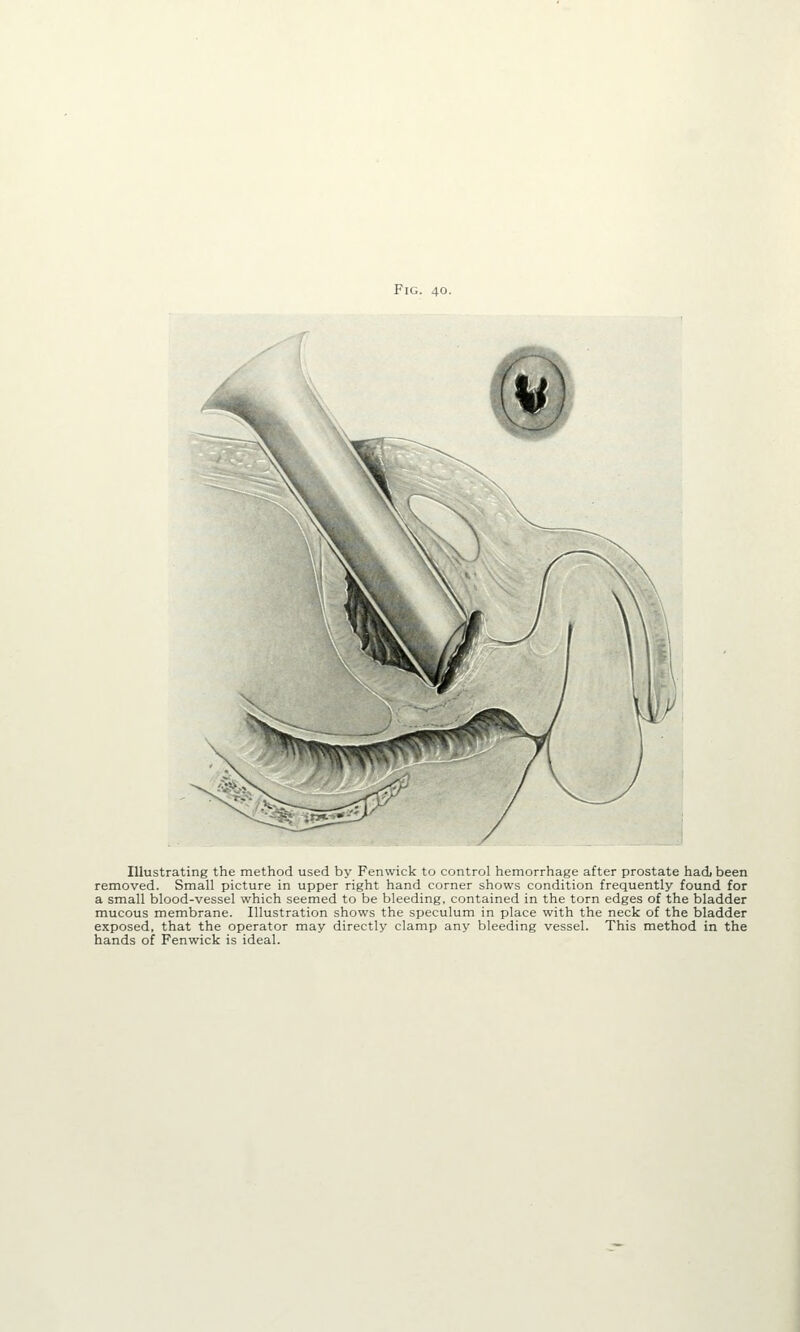 Illustrating the method used by Fenwick to control hemorrhage after prostate had been removed. Small picture in upper right hand corner shows condition frequently found for a small blood-vessel which seemed to be bleeding, contained in the torn edges of the bladder mucous membrane. Illustration shows the speculum in place with the neck of the bladder exposed, that the operator may directly clamp any bleeding vessel. This method in the hands of Fenwick is ideal.