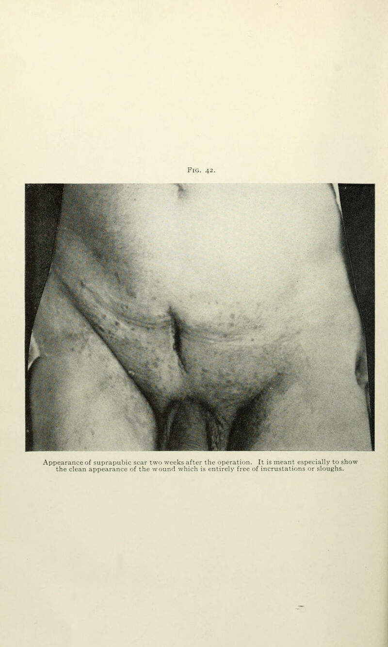 Appearance of suprapubic scar two weeks after the operation. It is meant especially to show the clean appearance of the wound which is entirely free of incrustations or sloughs.