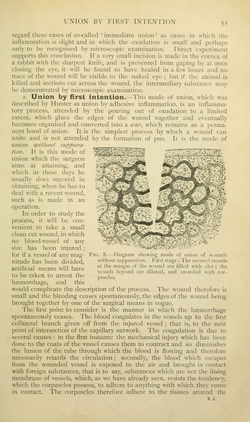 UNION J',V FIRST INllCNTION regard these cases of so-called ' immediate union ' as cases in which the inflammation is slight and in which the exudation is small and perhaps only to be recognised by microscopic examination. Direct experiment supports this conclusion. If a very small incision is made in the cornea of a rabbit with the sharpest knife, and is prevented from gaping by at once closing the eye, it will be found to have healed in a few hours and no trace of the wound will be visible to the naked eye ; but if the animal is killed and sections cut across the wound, the intermediary substance may be demonstrated by microscopic examination. 2. Union by first intention.—This mode of union, which was described by Hunter as union by adhesive inflammation, is an inflamma- tory process, attended by the pouring out of exudation to a limited extent, which glues the edges of the wound together and eventually becomes organised and converted into a scar^ which remains as a perma- nent bond of union. It is the simplest process by which a wound can unite and is not attended by the formation of pus. It is the mode of union without suppu7-a- tio/i. It is this mode of union which the surgeon aims at attaining, and which in these days he usually does succeed in obtaining, when he has to deal with a recent wound, such as is made in an operation. In order to study the process, it wall be con- venient to take a small clean cut wound, in which no blood-vessel of any size has been injured; for if a vessel of any mag- nitude has been divided, artificial means will have to be taken to arrest the haemorrhage, and this would complicate the description of the process. The wound therefore is small and the bleeding ceases spontaneously, the edges of the wound being brought together by one of the surgical means in vogue. The first point to consider is the manner in w'hich the haemorrhage spontaneously ceases. The blood coagulates in the vessels up to the first collateral branch given off from the injured vessel; that is, to the next point of intersection of the capillary network. The coagulation is due to several causes : in the first instance the mechanical injury which has been done to the coats of the vessel causes them to contract and so diminishes the lumen of the tube through which the blood is flowing and therefore necessarily retards the circulation; secondly, the blood which escapes from the wounded vessel is exposed to the air and brought in contact with foreign substances, that is to say, substances which are not the lining membrane of vessels, which, as we have already seen, resists the tendency, which the corpuscles possess, to adhere to anything with which they come in contact. The corpuscles therefore adhere to the tissues around the Fig. S.—Diagram showing mode of union of wounds without suppuration. First stage : The severed vessels at the margin of the wound are filled with clot ; the vessels beyond are dilated, and crowded with cor- puscles.
