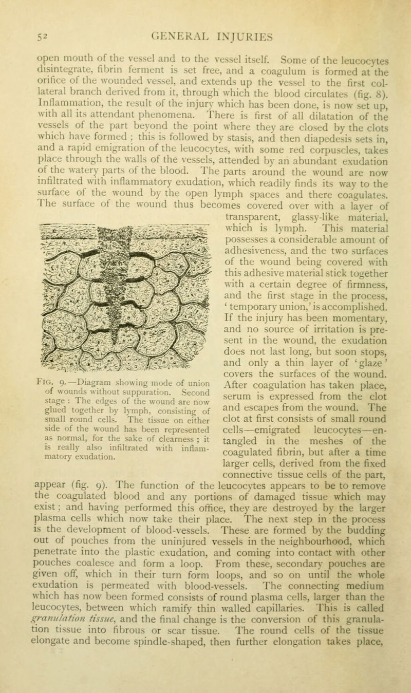 open mouth of the vessel and to the vessel itself. Some of the leucocytes disintegrate, fibrin ferment is set free, and a coagulum is formed at the orifice of the wounded vessel, and extends up the vessel to the first col- lateral branch derived from it, through which the blood circulates (fig. 8). Inflammation, the result of the injury which has been done, is now set up, with all its attendant phenomena. There is first of all dilatation of the vessels of the part beyond the point where they are closed by the clots which have formed ; this is followed by stasis, and then diapedesis sets in, and a rapid emigration of the leucocytes, with some red corpuscles, takes place through the walls of the vessels, attended by an abundant exudation of the watery parts of the blood. The parts around the wound are now infiltrated with inflammatory exudation, which readily finds its way to the surface of the wound by the open lymph spaces and there coagulates. The surface of the wound thus becomes covered over with a layer of transparent, glassy-like material, which is lymph. This material possesses a considerable amount of adhesiveness, and the two surfaces of the wound being covered with this adhesive material stick together with a certain degree of firmness, and the first stage in the process, ' temporary union,' is accomplished. If the injury has been momentary, and no source of irritation is pre- sent in the wound, the exudation does not last long, but soon stops, and only a thin layer of 'glaze' covers the surfaces of the wound. After coagulation has taken place, serum is expressed from the clot and escapes from the wound. The clot at first consists of small round cells—emigrated leucocytes—en- tangled in the meshes of the coagulated fibrin, but after a time larger cells, derived from the fixed connective tissue cells of the part, appear (fig. g). The function of the leucocytes appears to be to remove the coagulated blood and any portions of damaged tissue which may exist; and having performed this office, they are destroyed by the larger plasma cells which now take their place. The next step in the process is the development of blood-vessels. These are formed by the budding out of pouches from the uninjured vessels in the neighbourhood, which penetrate into the plastic exudation, and coming into contact with other pouches coalesce and form a loop. From these, secondary pouches are given off, which in their turn form loops, and so on until the whole extidation is permeated with blood-vessels. The connecting medium which has now been formed consists of round plasma cells, larger than the leucocytes, between which ramify thin walled capillaries. This is called ,i^raniilation tissue, and the final change is the conversion of this granula- tion tissue into fibrous or .scar tissue. The round cells of the tissue elongate and become spindle-shaped, then further elongation takes place, t IG. 9. —Diagram showing mode of union of wounds without suppuration. .Second stage : The edges of the wound are now glued together by lymph, consisting of small round cells. The tissue on either side of the wound has been represented as normal, for the sake of clearness ; it is really also infiltrated with inflam- matory exudation.