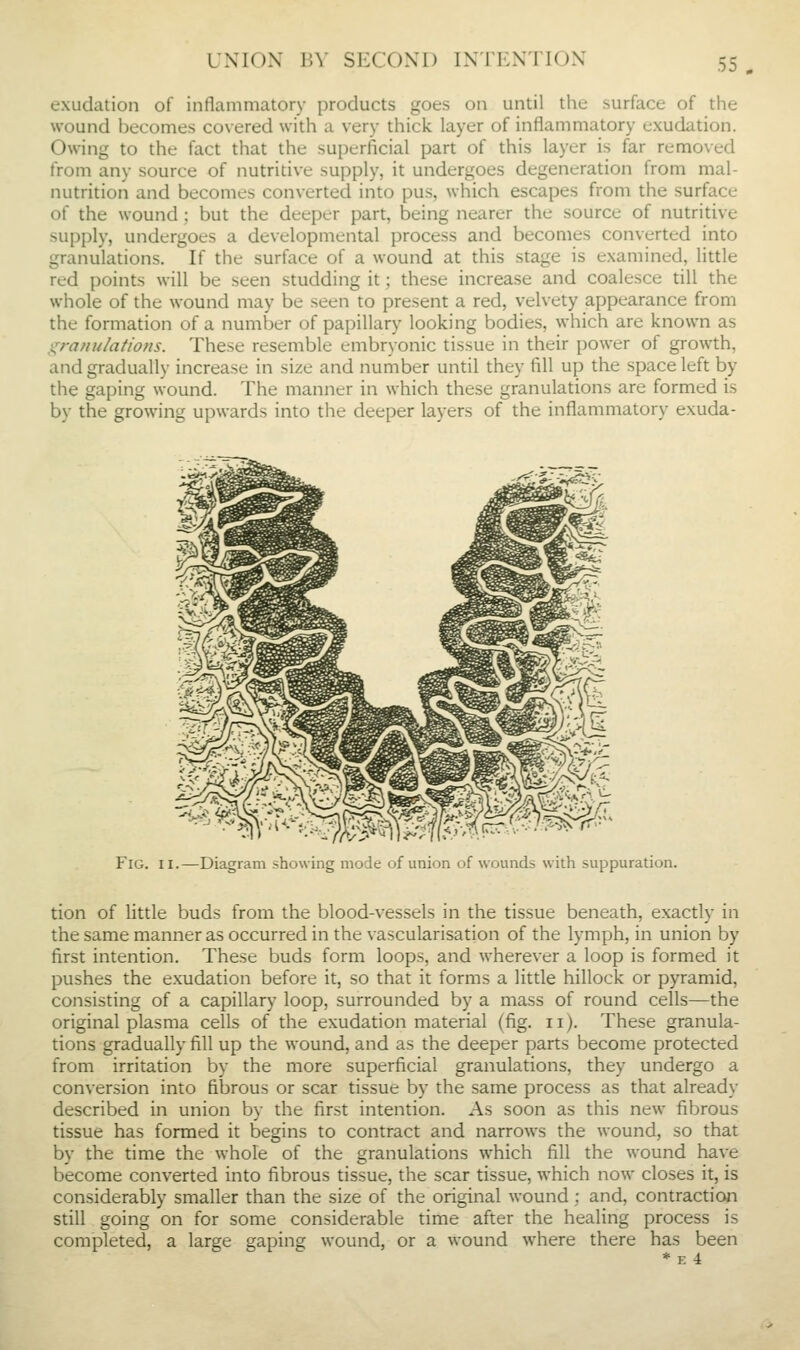 UNION BV SECOND INTENTION exudation of inflammatory products goes on until the surface of the wound becomes covered with a very thick layer of inflammatory exudation. Owing to the fact that the superficial part of this layer is far removed from any source of nutritive supply, it undergoes degeneration from mal- nutrition and becomes converted into pus, which escapes from the surface of the wound ; but the deeper part, being nearer the source of nutritive supply, undergoes a developmental process and becomes converted into granulations. If the surface of a wound at this stage is examined, little red points will be seen studding it; these increase and coalesce till the whole of the wound may be seen to present a red, velvety appearance from the formation of a number of papillary looking bodies, which are known as granulations. These resemble embryonic tissue in their power of growth, and gradually increase in size and number until they fill up the space left by the gaping wound. The manner in which these granulations are formed is by the growing upwards into the deeper layers of the inflammatory exuda- FiG. II.—Diagram showing mode of union of wounds with suppuration. tion of little buds from the blood-vessels in the tissue beneath, exactly in the same manner as occurred in the vascularisation of the lymph, in union by first intention. These buds form loops, and wherever a loop is formed it pushes the exudation before it, so that it forms a little hillock or pyramid, consisting of a capillary loop, surrounded by a mass of round cells—the original plasma cells of the exudation material (fig. ii). These granula- tions gradually fill up the wound, and as the deeper parts become protected from irritation by the more superficial granulations, they undergo a conversion into fibrous or scar tissue by the same process as that already described in union by the first intention. As soon as this new fibrous tissue has formed it begins to contract and narrows the wound, so that by the time the whole of the granulations which fill the wound have become converted into fibrous tissue, the scar tissue, which now closes it, is considerably smaller than the size of the original wound; and, contraction still going on for some considerable time after the healing process is completed, a large gaping wound, or a wound where there has been * E 4