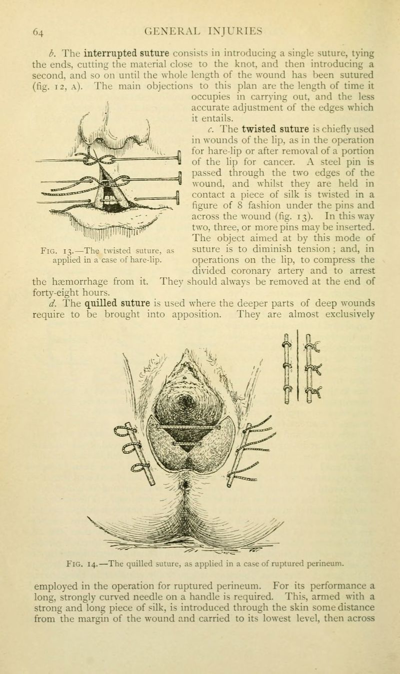 b. The interrupted suture consists in introducing a single suture, tying the ends, cutting the material close to the knot, and then introducing a second, and so on until the whole length of the wound has been sutured (fig. 12, a). The main objections to this plan are the length of time it occupies in carrying out, and the less accurate adjustment of the edges which it entails. c. The twisted suture is chiefly used in wounds of the lip, as in the operation for hare-lip or after removal of a portion of the lip for cancer. A steel pin is passed through the two edges of the wound, and whilst they are held in contact a piece of silk is twisted in a figure of 8 fashion under the pins and across the wound (fig. 13). In this way two, three, or more pins may be inserted. The object aimed at by this mode of suture is to diminish tension ; and, in operations on the lip, to compress the divided coronary artery and to arrest the haemorrhage from it. They should always be removed at the end of forty-eight hours. d. The quilled suture is used where the deeper parts of deep wounds require to be brought into apposition. They are almost exclusively Fig. 13.—The twisted suture, applied in a case of hare-lip. Fig. 14.—The quilled suture, as applied in a case of ruptured perineum. employed in the operation for ruptured perineum. For its performance a long, strongly curved needle on a handle is required. This, armed with a strong and long piece of silk, is introduced through the skin some distance from the margin of the wound and carried to its lowest level, then across