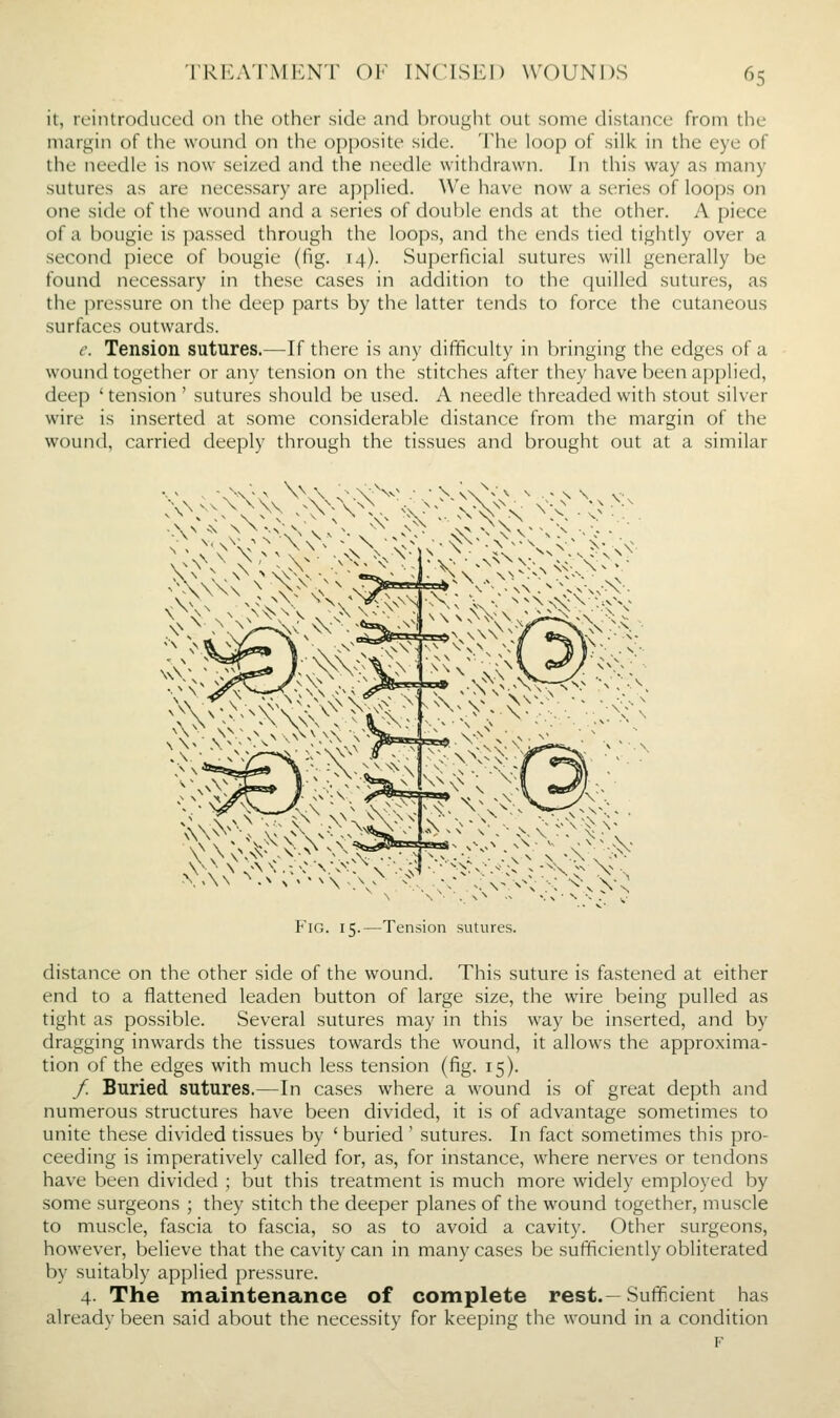 it, reintroduced on tlie other side and hrougiit out some distance from the margin of the wound on the opposite side. The loop of silk in the eye of the needle is now seized and the needle withdrawn. In this way as many sutures as are necessary are applied. We have now a series of loops on one side of the wound and a series of double ends at the other. A piece of a bougie is passed through the loops, and the ends tied tightly over a second piece of bougie (fig. 14). Superficial sutures will generally be found necessary in these cases in addition to the quilled sutures, as the pressure on the deep parts by the latter tends to force the cutaneous surfaces outwards. e. Tension sutures.—If there is any difficulty in bringing the edges of a wound together or an\- tension on the stitches after they have been applied, deep ' tension ' sutures should be used. A needle threaded with stout silver wire is inserted at some considerable distance from the margin of the wound, carried deeply through the tissues and brought out at a similar v^^v^^>SoS^^ Pig. 15.—Tension sutures. distance on the other side of the wound. This suture is fastened at either end to a flattened leaden button of large size, the wire being pulled as tight as possible. Several sutures may in this way be inserted, and by dragging inwards the tissues towards the wound, it allows the approxima- tion of the edges with much less tension (fig. 15). f. Buried sutures.—In cases where a wound is of great depth and numerous structures have been divided, it is of advantage sometimes to unite these divided tissues by ' buried ' sutures. In fact sometimes this pro- ceeding is imperatively called for, as, for instance, where nerves or tendons have been divided ; but this treatment is much more widely employed by some surgeons ; they stitch the deeper planes of the wound together, muscle to muscle, fascia to fascia, so as to avoid a cavity. Other surgeons, however, believe that the cavity can in many cases be sufficiently obliterated by suitably applied pressure. 4. The maintenance of complete rest.—Sufficient has already been said about the necessity for keeping the wound in a condition F