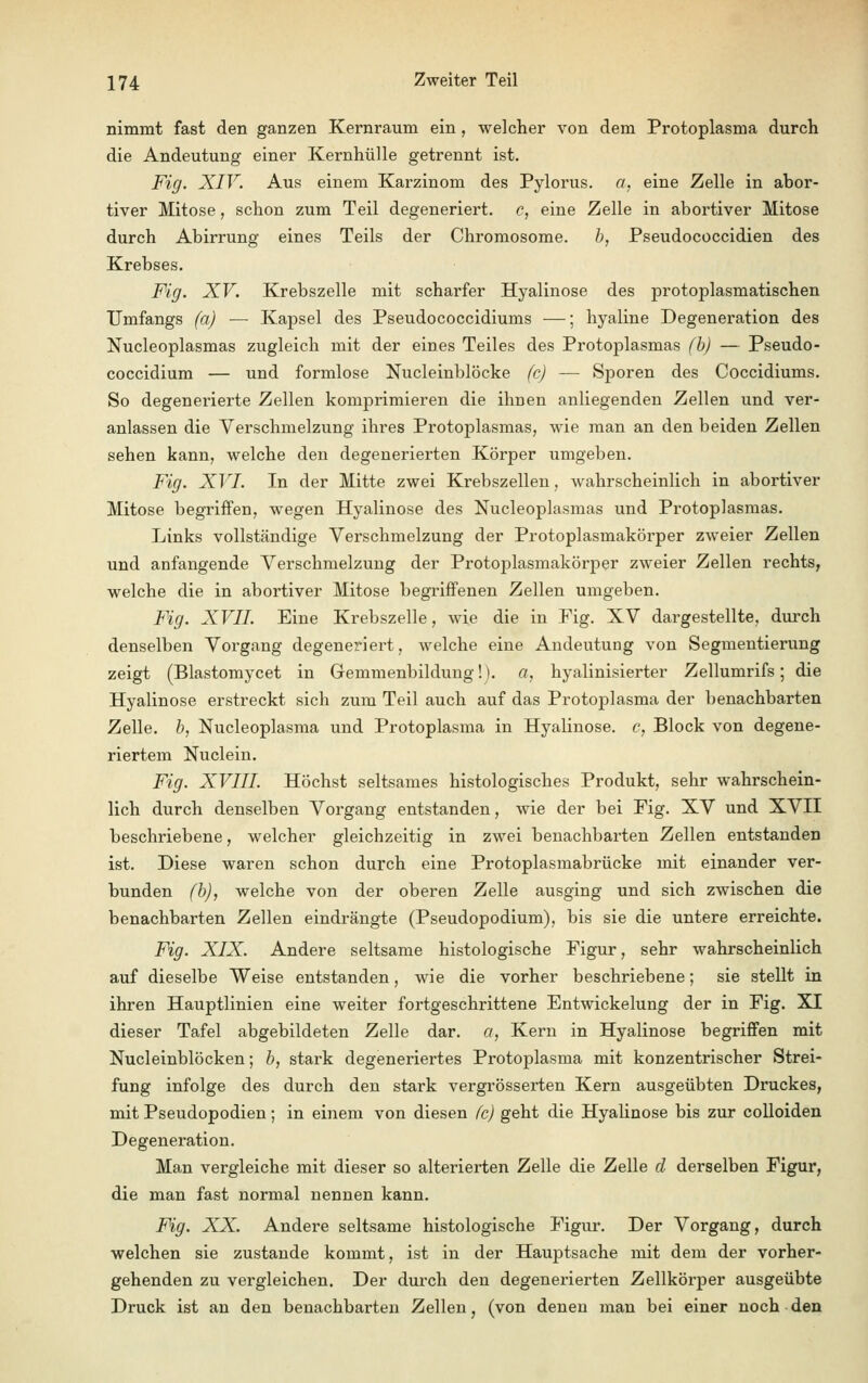 nimmt fast den ganzen Kernraum ein , welcher von dem Protoplasma durch die Andeutung einer Kernhülle getrennt ist. Fig. XIV. Aus einem Karzinom des Pylorus. a, eine Zelle in abor- tiver Mitose, schon zum Teil degeneriert, c, eine Zelle in abortiver Mitose durch Abirrung eines Teils der Chromosome. b, Pseudococcidien des Krebses. Fig. XV. Krebszelle mit scharfer Hyalinose des protoplasmatischen TJmfangs (a) — Kapsel des Pseudococcidiums —; hyaline Degeneration des Nucleoplasmas zugleich mit der eines Teiles des Protoplasmas (b) — Pseudo- coccidium — und formlose Nucleinblöcke (c) — Sporen des Coccidiums. So degenerierte Zellen komprimieren die ihnen anliegenden Zellen und ver- anlassen die Verschmelzung ihres Protoplasmas, wie man an den beiden Zellen sehen kann, welche den degenerierten Körper umgeben. Fig. XVI. In der Mitte zwei Krebszellen, wahrscheinlich in abortiver Mitose begriffen, wegen Hyalinose des Nucleoplasmas und Protoplasmas. Links vollständige Verschmelzung der Protoplasmakörper zweier Zellen und anfangende Verschmelzung der Protoplasmakörper zweier Zellen rechts, welche die in abortiver Mitose begriffenen Zellen umgeben. Fig. XVII. Eine Krebszelle, wie die in Fig. XV dargestellte, durch denselben Vorgang degeneriert, welche eine Andeutung von Segmentierung zeigt (Blastomycet in Gemmenbildung!), a, hyalinisierter Zellumrifs; die Hyalinose erstreckt sich zum Teil auch auf das Protoplasma der benachbarten Zelle, b, Nucleoplasma und Protoplasma in Hyalinose. c, Block von degene- riertem Nuclein. Fig. XVIII. Höchst seltsames histologisches Produkt, sehr wahrschein- lich durch denselben Vorgang entstanden, wie der bei Fig. XV und XVII beschriebene, welcher gleichzeitig in zwei benachbarten Zellen entstanden ist. Diese waren schon durch eine Protoplasmabrücke mit einander ver- bunden (b), welche von der oberen Zelle ausging und sich zwischen die benachbarten Zellen eindrängte (Pseudopodium), bis sie die untere erreichte. Fig. XIX. Andere seltsame histologische Figur, sehr wahrscheinlich auf dieselbe Weise entstanden, wie die vorher beschriebene; sie stellt in ihren Hauptlinien eine weiter fortgeschrittene Entwickelung der in Fig. XI dieser Tafel abgebildeten Zelle dar. a, Kern in Hyalinose begriffen mit Nucleinblöcken; b, stark degeneriertes Protoplasma mit konzentrischer Strei- fung infolge des durch den stark vergrösserten Kern ausgeübten Druckes, mit Pseudopodien; in einem von diesen fc) geht die Hyalinose bis zur colloiden Degeneration. Man vergleiche mit dieser so alterierten Zelle die Zelle d derselben Figur, die man fast normal nennen kann. Fig. XX. Andere seltsame histologische Figur. Der Vorgang, durch welchen sie zustande kommt, ist in der Hauptsache mit dem der vorher- gehenden zu vergleichen. Der durch den degenerierten Zellkörper ausgeübte Druck ist an den benachbarten Zellen, (von denen man bei einer noch den