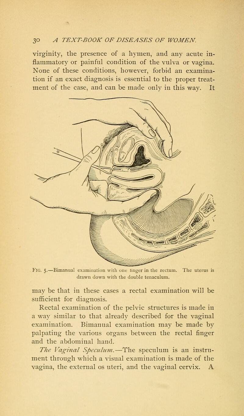 virginity, the presence of a hymen, and any acute in- flammatory or painful condition of the vulva or vagina. None of these conditions, however, forbid an examina- tion if an exact diagnosis is essential to the proper treat- ment of the case, and can be made only in this way. It PlG. 5-—Bimanual examination with one nnger in the rectum. Tlie uterus is drawn down witii the double tenaculum. may be that in these cases a rectal examination will be sufficient for diagnosis. Rectal examination of the pelvic structures is made in a way similar to that already described for the vaginal examination. Bimanual examination may be made by palpating the various organs between the rectal finger and the abdominal hand. The Vaginal Speculum,.—The speculum is an instru- ment through which a visual examination is made of the vagina, the external os uteri, and the vaginal cervix. A