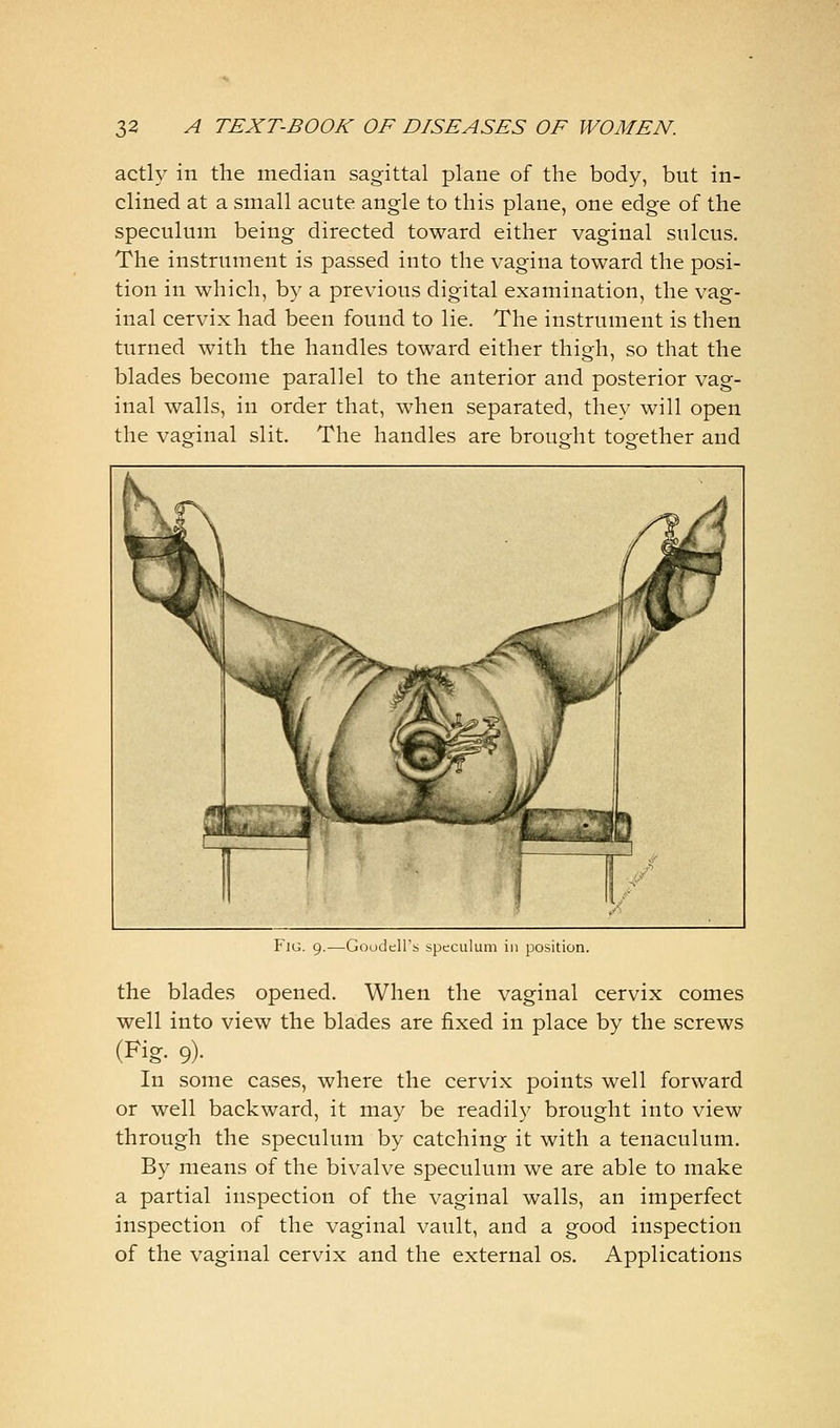 actly in the median sagittal plane of the body, but in- clined at a small acute angle to this plane, one edge of the speculum being directed toward either vaginal sulcus. The instrument is passed into the vagina toward the posi- tion in which, by a previous digital examination, the vag- inal cervix had been found to lie. The instrument is then turned with the handles toward either thigh, so that the blades become parallel to the anterior and posterior vag- inal walls, in order that, when separated, they will open the vaginal slit. The handles are brought together and Fig. 9.—Goodell's speculum in position. the blades opened. When the vaginal cervix comes well into view the blades are fixed in place by the screws (I^ig- 9)- In some cases, where the cervix points well forward or well backward, it may be readily brought into view through the speculum by catching it with a tenaculum. By means of the bivalve speculum we are able to make a partial inspection of the vaginal walls, an imperfect inspection of the vaginal vault, and a good inspection of the vaginal cervix and the external os. Applications