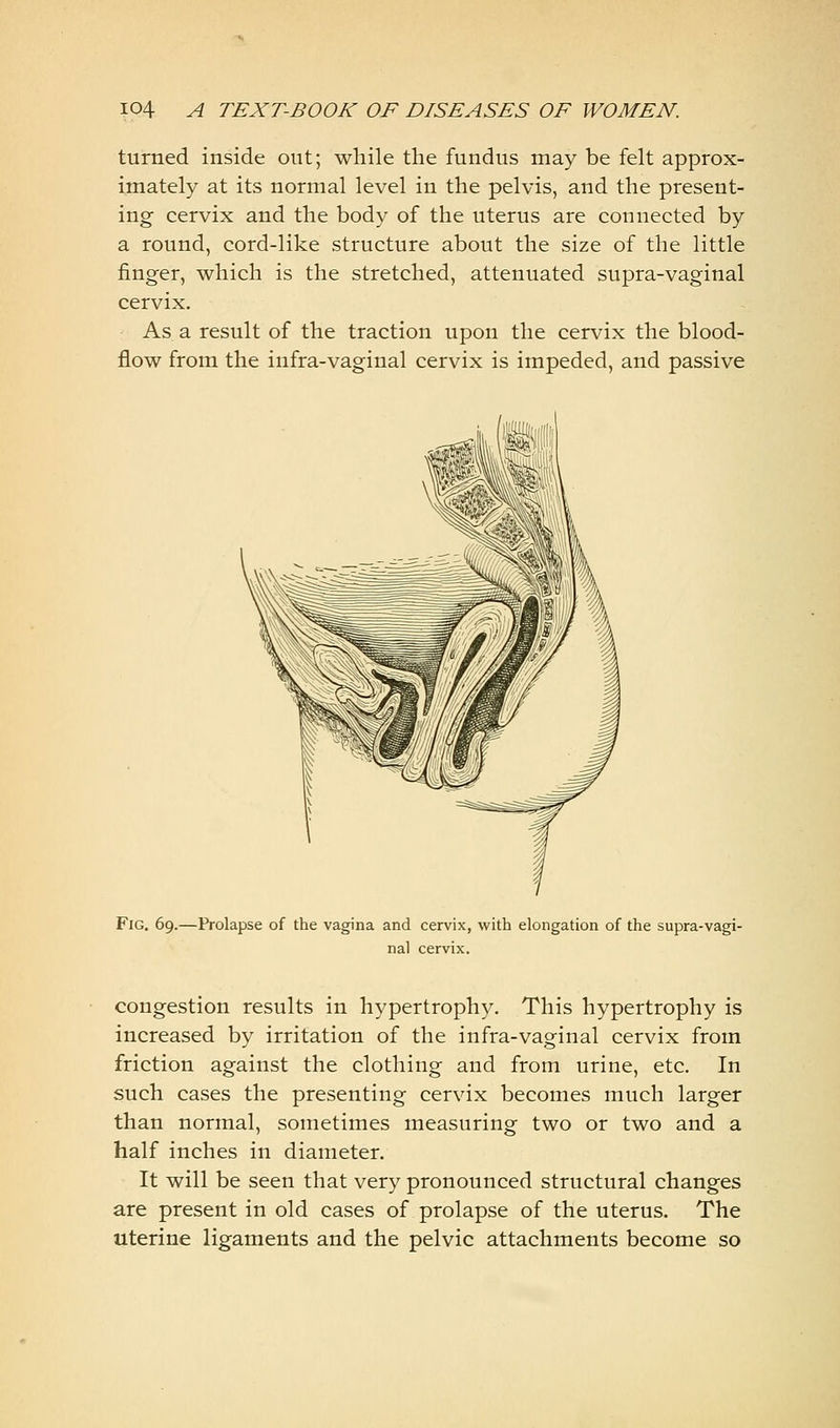 turned inside out; while the fundus may be felt approx- imately at its normal level in the pelvis, and the present- ing cervix and the body of the uterus are connected by a round, cord-like structure about the size of the little finger, which is the stretched, attenuated supra-vaginal cervix. As a result of the traction upon the cervix the blood- flow from the infra-vaginal cervix is impeded, and passive Fig. 69.—Prolapse of the vagina and cervix, with elongation of the supra-vagi- nal cervix. congestion results in hypertrophy. This hypertrophy is increased by irritation of the infra-vaginal cervix from friction against the clothing and from urine, etc. In such cases the presenting cervix becomes much larger than normal, sometimes measuring two or two and a half inches in diameter. It will be seen that very pronounced structural changes are present in old cases of prolapse of the uterus. The uterine ligaments and the pelvic attachments become so