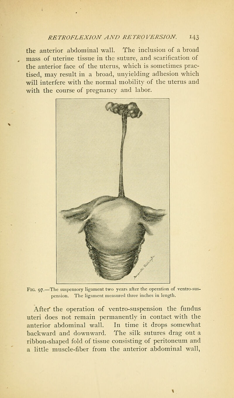 the anterior abdominal wall. The inclusion of a broad mass of uterine tissue in the suture, and scarification of the anterior face of the uterus, which is sometimes prac- tised, may result in a broad, unyielding adhesion which will interfere with the normal mobility of the uterus and with the course of pregnancy and labor. Fig. 97.—The suspensory ligament two years after the operation of ventro-sus- pension. The ligament measured three inches in length. Aftef the operation of ventro-suspension the fundus uteri does not remain permanently in contact with the anterior abdominal wall. In time it drops somewhat backward and downward. The silk sutures drag out a ribbon-shaped fold of tissue consisting of peritoneum and a little muscle-fiber from the anterior abdominal wall,