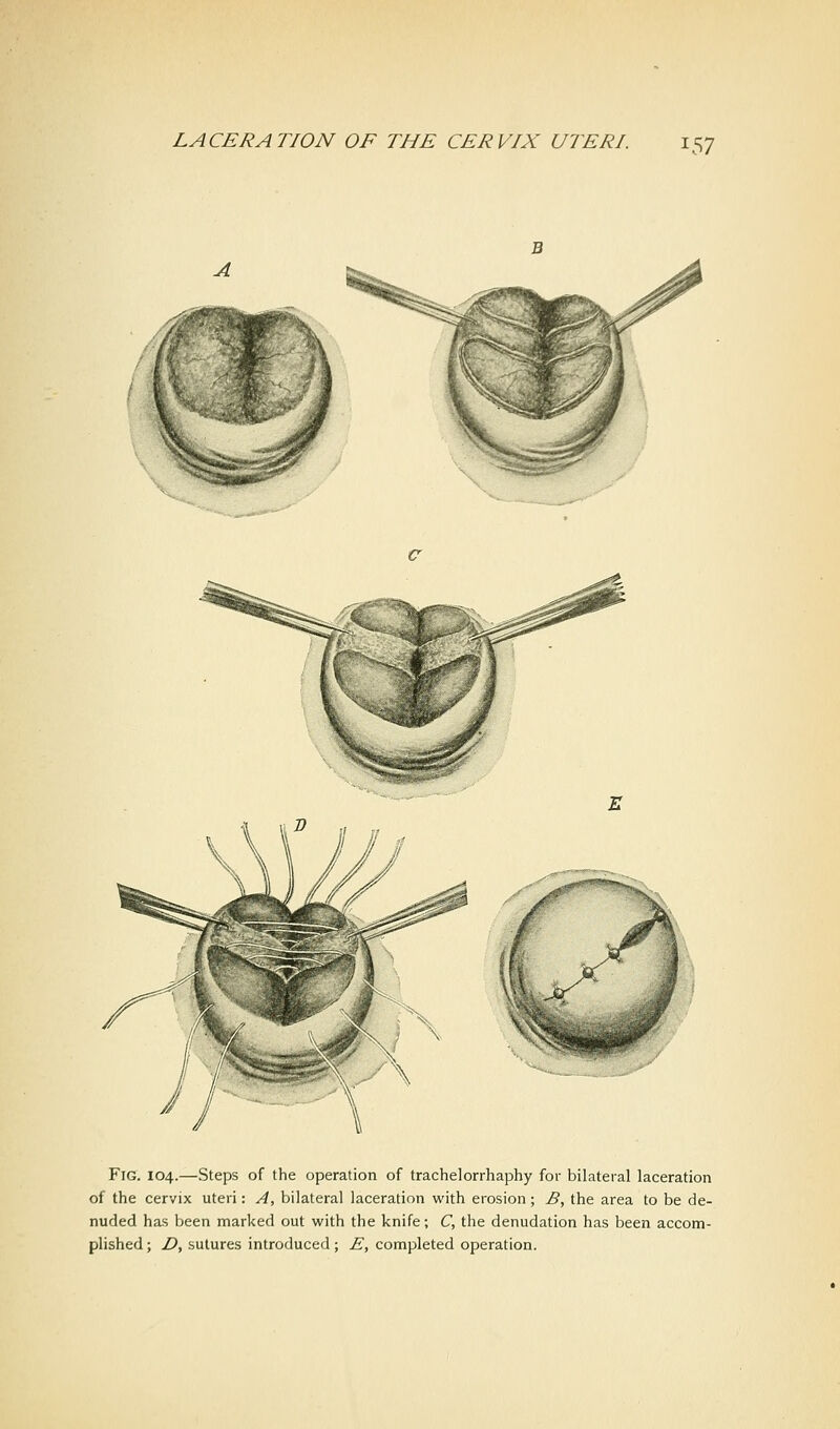 Fig. 104.—Steps of the operation of trachelorrhaphy for bilateral laceration of the cervix uteri: A, bilateral laceration with erosion; B, the area to be de- nuded has been marked out with the knife; C, the denudation has been accom- plished ; D, sutures introduced; E, completed operation.