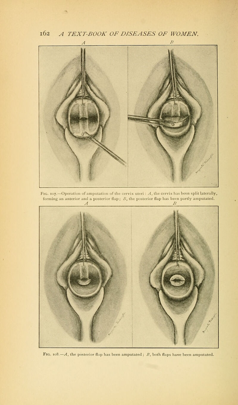 A B Fig. 107.—Operation of amputation of the cervix uteri : A, the cervix has been split laterally, forming an anterior and a posterior flap; B, the posterior flap has been partly amputated. A B Fig. 108.—A, the posterior flap has been amputated; B, both flaps have been amputated.