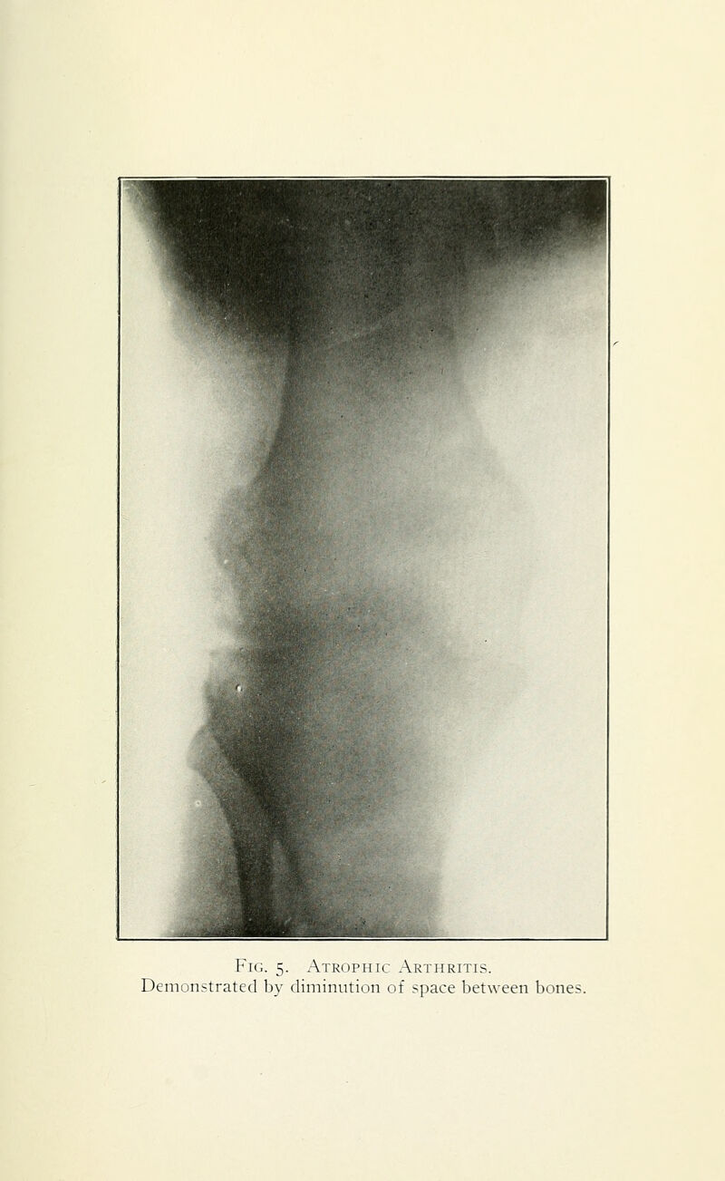 Demonstrated by diminution of space between bones.