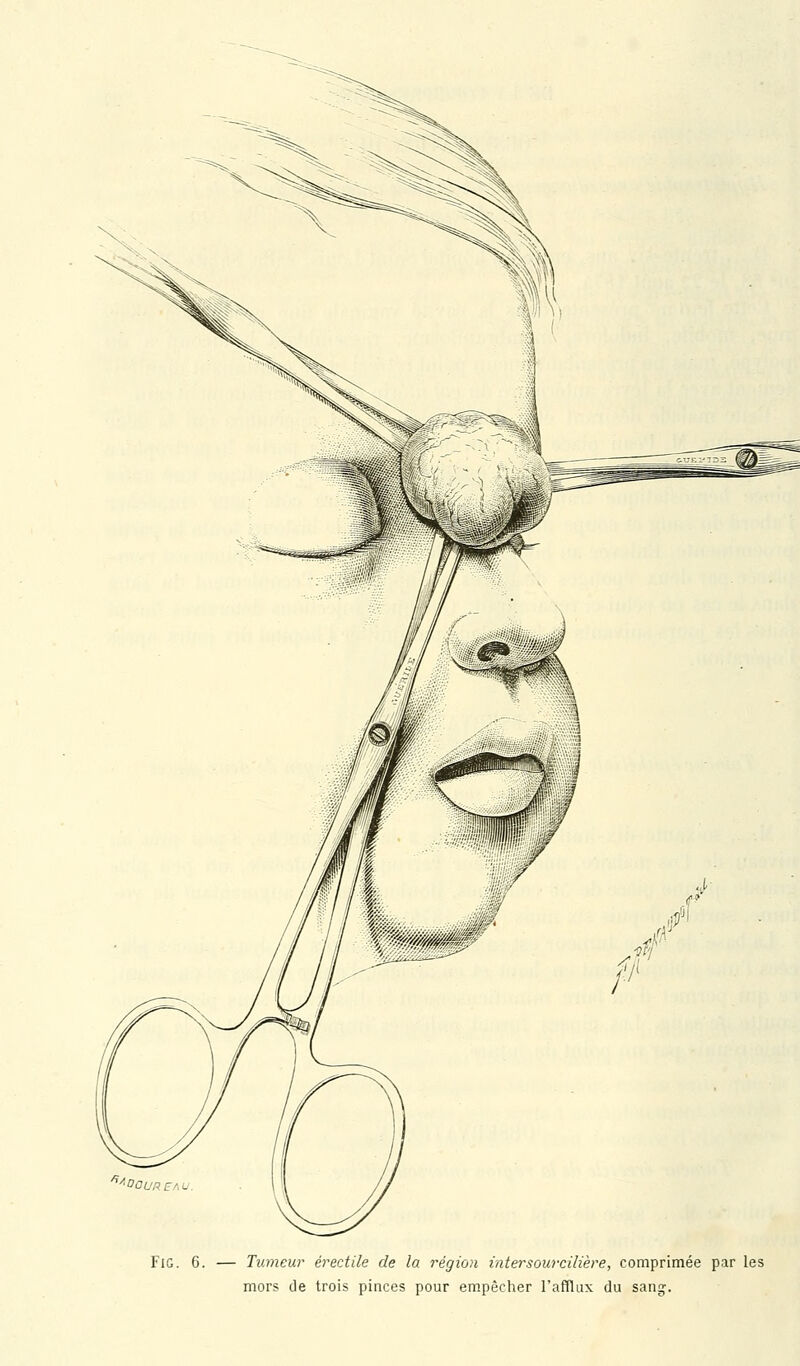 FiG. 6. — Tumeur érectile de la région intersourcilière, comprimée par les mors de trois pinces pour empêcher l'afflux du sang.