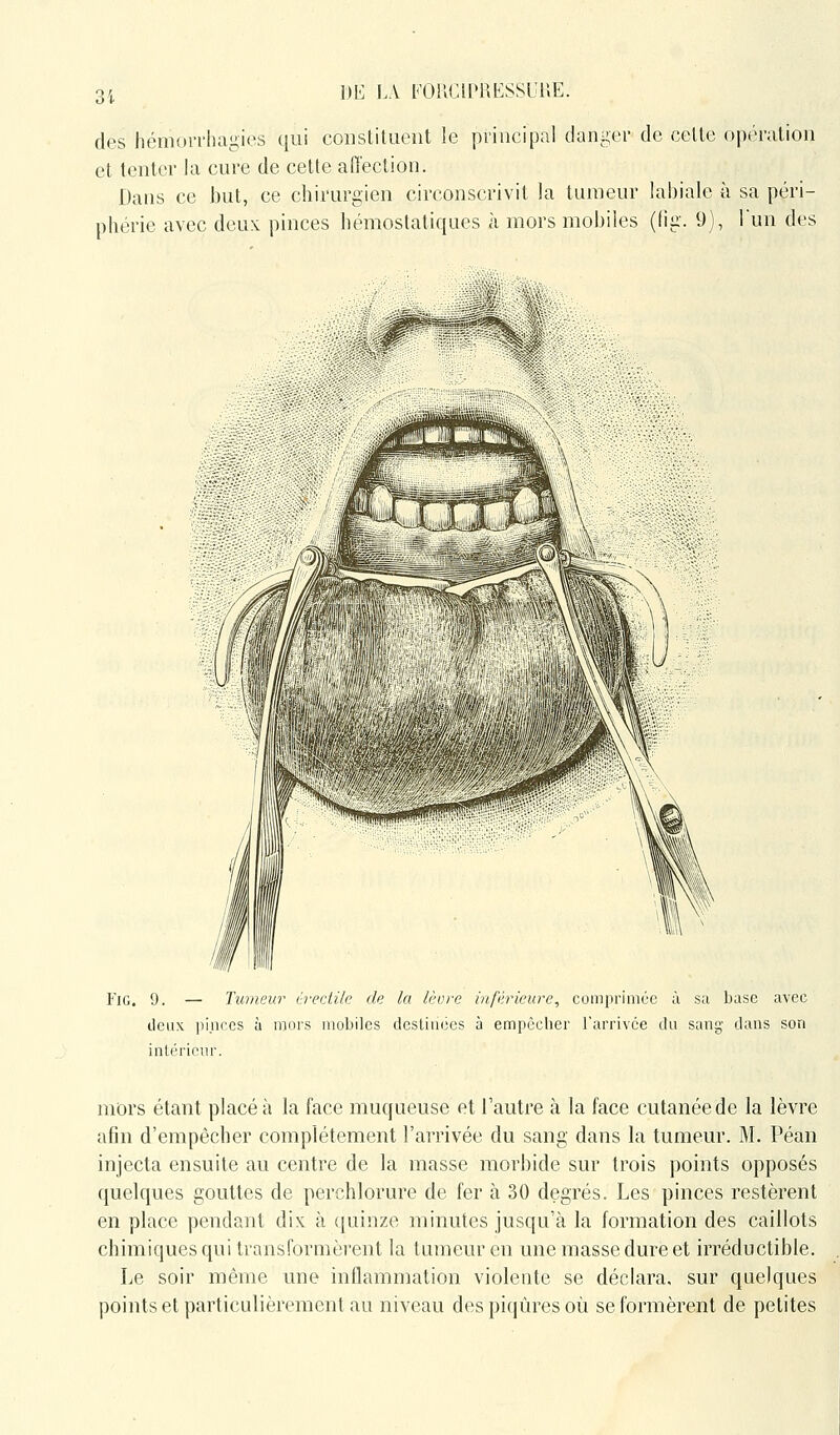 m LA KOUCIPRESSUI'.E. des hémorrhagies qui coiistiluoiit le principal danger de celle opéralion et tenlcr la cure de cette affection. Dans ce but, ce chirurgien circonscrivit la tumeur labiale à sa péri- phérie avec deux pinces hémostatiques à mors mobiles (fig. 9), Tun des YiG. 9. — Tumeur i-recii/e de la lèore inférieure, comprimée à sa base avec deux ])i.iiccs ù mors mobiles desliuces à empocher l'arrivée du sang dans son intérieur. mors étant placé à la face muqueuse et l'autre à la face cutanée de la lèvre afin d'empêcher complètement l'arrivée du sang dans la tumeur. M. Péan injecta ensuite au centre de la masse morbide sur trois points opposés quelques gouttes de perchlorure de fer à 30 degrés. Les pinces restèrent en place pendant dix h ([uinze minutes jusqu'à la formation des caillots chimiques qui transformèrent la tumeur en une masse dure et irréductible. Le soir même une inflammation violente se déclara, sur quelques pointset particulièrement au niveau des piqûres où se formèrent de petites