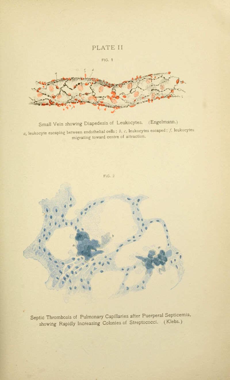 FIG. 1 c I, Small Vein showing Diapedesis of Leukocytes. (Engelmann.) ., leukocyte escaping between endothelial cells ; b, c, leukocytes escaped ; /, leukocytes migrating toward centre of attraction. FiG. 2 * <9 Septic Thrombosis of Pulmonary Capillaries after Puerperal Septicemia, showing Rapidly Increasing Colonies of Streptococci. (Klebs.)