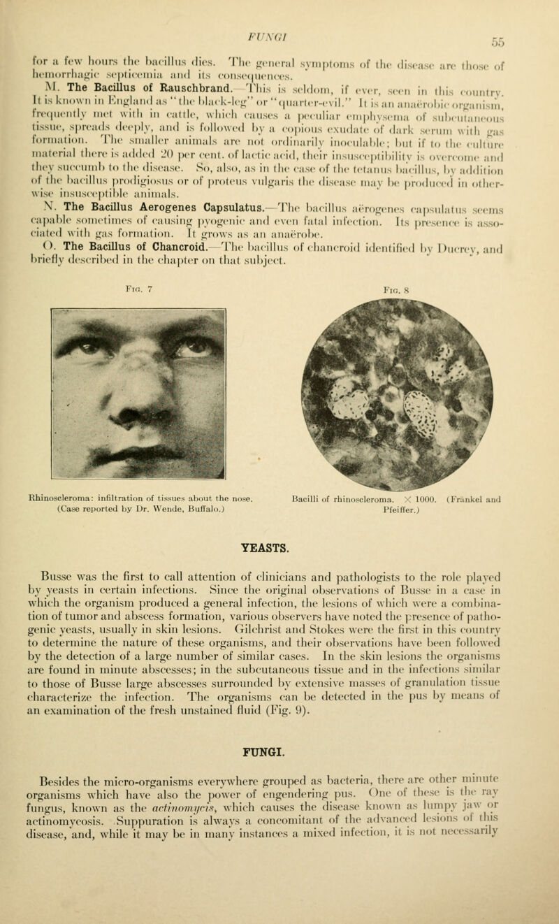 FUNGI 55 for a tVw hours tlic hacilliis dies. 'V\h- ovncral syinploiiis of the dis.'asc arc those <.f heiiioiTlia^ic septicemia and ils coiisc(|iiciiccs. M. The Bacillus of Rauschbrand. This is seldom, if ever, seen in this eonntrv. It is known in Kn^land as the hhick-lcn; <,r (|nartcr-<-viL It is an anacrohic or^ranisiii^ fiT(|Ucntl.v met with in cattle, which causes a peculiar empiiyseina of suhcntaneous tissue, spreads deeply, and is followed hy a copious exuchitc of dark scrum with j;as formation. The smaller animals are not ordinarily inoculahie; hut if to the culture niJiterial there is added L'O j)er cent, of lactic acid, their insusce|)tihility is overcome and they siiccumh to the (hsease. So, also, as in the case of the tetanus haCillus, hy a<lrliti()n of the l)acilius prodi<,nosus or of proteus vul<faris the disease may he |)roduced in other- wise insusceptihlc animals. .\. The Bacillus Aerogenes Capsulatus. 'I'h<- hacilhis ai'ro^fcncs capsulatus seems capable sometimes of caiisin<j pyotrenic and even fatal infection. Its presence is a.sso- ciated with <xas formation. It ffrows as an aiiaj'rohc. (). The Bacillus of Chancroid,—The bacillus of chancroid identified hv Ducrev, and briefly tlescribed in (he chapter on tliat subject. Fin. 7 Fio. 8 Rhinoscleroma: infiltration of tissues about the no.se. (Case reported by Dr. Wende, Buffalo.) Bacilli of rhino.^cleroui: Pfeiffer.) YEASTS. Busse was the first to call attention of clinicians and patholofiists to the role played by yeasts in certain infections. Since the original observations of Bus.se in a case in which the organism produced a general infection, the lesions of which were a combina- tion of tumor and abscess formation, various observers have noted the presence of patho- genic yeasts, usually in skin lesions. Gilchrist and Stokes were the first in this country to determine the nature of these organisms, and their observations have been followed by the detection of a large number of similar cases. In the skin lesions the organisms are found in minute abscesses; in the subcutaneous ti.ssue and in the infcctif)ns similar to tho.se of Bu.s.se large absces.ses surrounded by extensive ma.s.ses of granulation tissue characterize the infection. The organisms can be detected in the pus by means of an examination of the fresh unstained fluid (Fig. 9). FUNGI. Besides the micro-organisms ever\^vhere grouped as bacteria, there are other minute organisms which have also the power of engendering pus. One of th(>sc is the ray fungus, known as the acHnomycis, which causes the disease known as lumpy jaw {)r actinomycosis. Suppuration i.s always a concomitant of the advanced lesions ot this disease, and, while it may be in many instances a mixed infection, it is not necessarily
