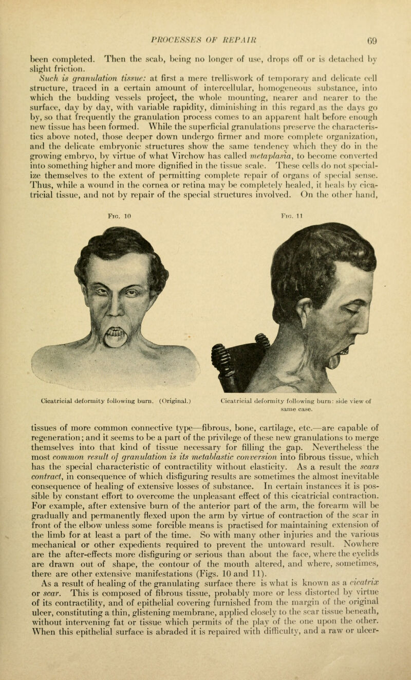 been complotod. Then the seal), hciiifj^ no l(tiiif( r of use, drops ofT or is dctiichrd hy slitjlit friction. Such U granulation tissue: at first a mere trelliswork of temporary and delicate cell structure, traced in a certain amount of intercellular, honio<jeiieous substance, into which the buddiiijjj vessels j)roject, the whole mouiitinir, nearer an<l nearer to the surfaci', day by day, with variable rapidity, diininisliiiif^ in this rciijard as the days j^o by, so that frc(|ucntly tiie fjranulation proc-css comes to an ap|)arcnt hah before enoujjh new tissue has be(>n formed. While the superficial (granulations preserve the characteri.s- tics above noted, those deeper down under<i^o firmer an<l more c()m[iletc or<rariization, and the delicate embryonic structures show the same tendency wliich they do in the growing embryo, by virtue of what Virchow has called v^rtapla.tia, to become converted into something higher and more dignified in the tissue scale. The.se cells do not special- ize themselves to the extent of permitting complete repair of organs of special sen.se. Thus, while a wound in the cornea or retina may be completely healed, it heals by cica- tricial tissue, and not by repair of the special structures involved. On the other liand, Fig. 10 Fir;, n Cicatricial deformity following bum. (Original.; Cicatricial tleformity fdl - ii„ same case. le view of tissues of more common connective type—fibrous, bone, cartilage, etc.—are capable of regeneration; and it seems to be a part of the privilege of these new granulations to merge themselves into that kind of tissue necessary for filling the gap. Nevertheless the most common result of granulation is its metablastic conversion into fibrous tissue, which has the special characteristic of contractility without elasticity. As a result the scars contract, in consequence of which disfiguring results are sometimes the almost inevitable consequence of healing of extensive losses of substance. In certain instances it is pos- sible by constant effort to overcome the unpleasant effect of this cicatricial contraction. For example, after extensive burn of the anterior part of the arm, the forearm will be gradually and permanently flexed upon the arm by virtue of contraction of the scar in front of the elbow unless some forcible means is practised for maintaining extension of the limb for at least a part of the time. So with many other injuries and the various mechanical or other expedients required to prevent the untoward result. Nowhere are the after-effects more disfiguring or serious than about the face, where the eyelids are drawn out of shape, the contour of the mouth altered, and where, sometimes, there are other extensive manifestations (Figs. 10 and 11). As a result of healing of the granulating surface there is what is known as a cicatrix or scar. This is composed of fibrous tissue, probably more or less distorted by virtue of its contractility, and of epithelial covering furnished from the margin of the original ulcer, constituting a thin, glistening membrane, applied clo.sely to the scar tissue beneath, without intervening fat or tissue which permits of the play of the one upon the other. When this epithelial surface is abraded it is repaired with difficulty, and a raw or ulcer-