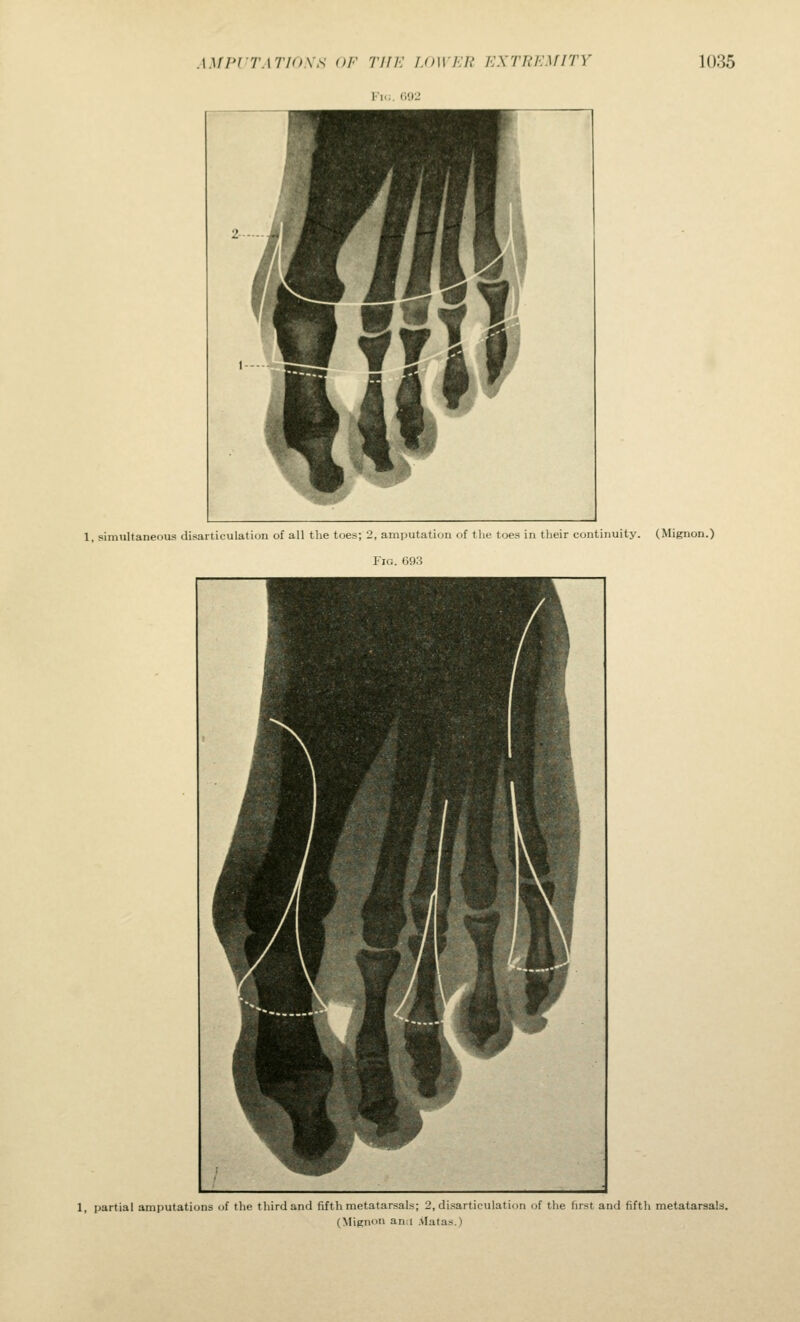 .\.\fl'l TATIOXS OF Till-: LOW EH EXTREMITY Fi.;. ri02 1035 1, simultaneous disarticulation of all the toes; 2, amputation of the toes in their continuity. (Migiion.) Fic;. 693 1, partial amputations uf the third and fifth metatarsals; 2, disarticulation of the first and fifth metatarsals. (Mignon ana Alatas.)