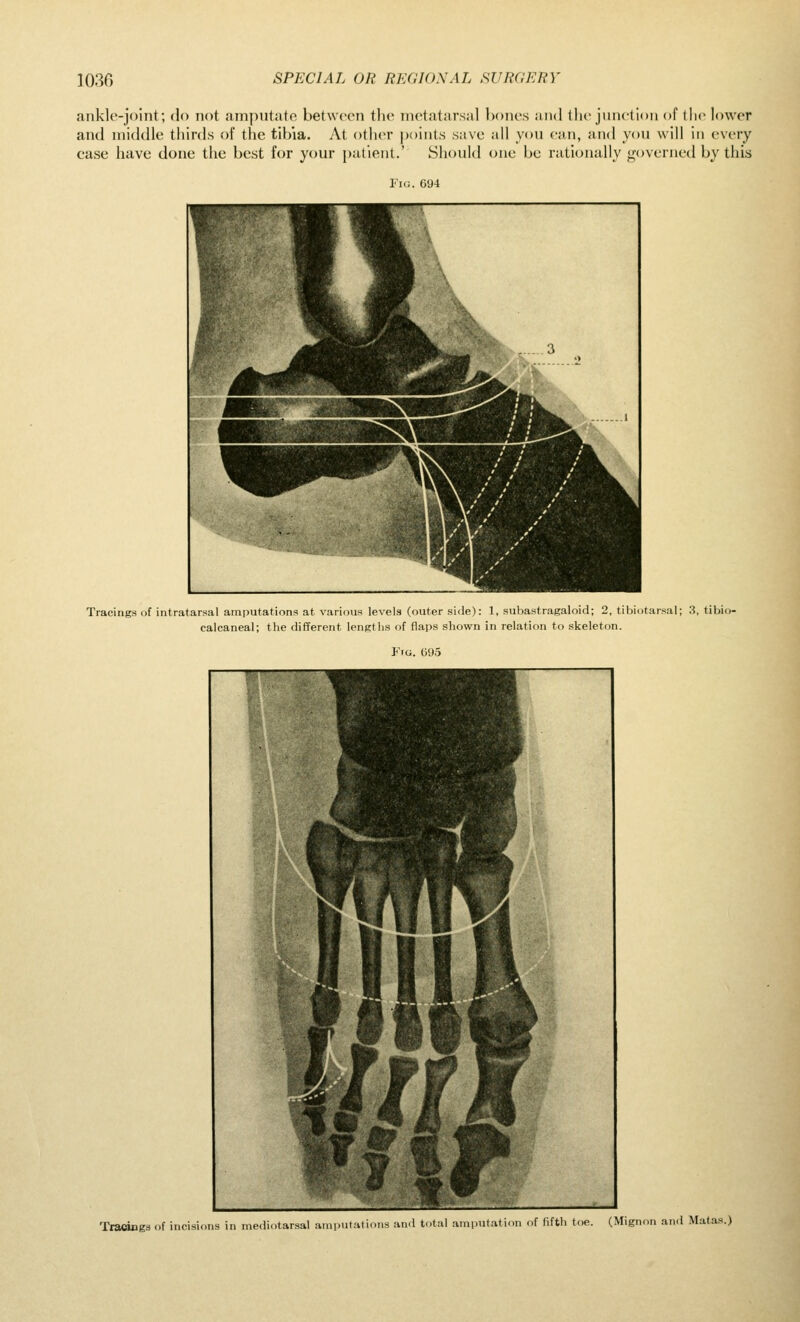 ankle-joint; do not amputate between tlie metatarsal bones and the junction (jf tlie lower and middle thirds of the tibia. At other points save all you can, and you will in every case have done the best for your patient.' Should one be rationally governed by this Fig. 694 Tracings of intratarsal amputations at various levels (outer side): 1, subastragaloid; 2, tibiutarsal; 3, tibio- calcaneal; the different lengths of flaps shown in relation to skeleton. Fig. 095 Tracings of incisions in mediotarsal anipuliuiu,,.^ and t..tul .aiaputatinu ,,f fifth toe. (Mignon and Matas.)