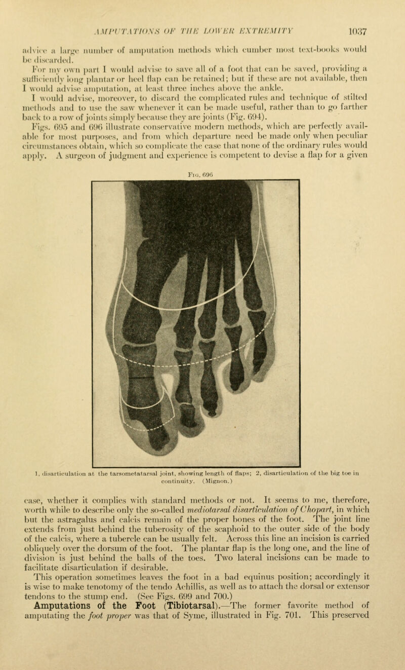 wri'i 'iwno.xs of riir. loweu iixriiiiMirv WM advice :i lar;,'*' iiiiiuIxT of aiiipiitatioii iucUkxIs wliicli c'Uiii1>(.t most k'.\t-l)ook.s would be discarded. For my own part I would advise to save all ol a foot that can he saved, providiiijf a sufficiently ioii<; plantar or heel flap can In* retained; but if these are not available, then I would advisi' amputation, at least three inches above the ankle. I would advise, moreover, to discard the eomplicated rules and technicpu; of stilted methods and to use the saw whenever it can be made useful, rather than to <,'<> farther back to a row of joints simply because they are joints (Fi<;. ()i)4). Fitjs. (')*)5 and (')!>() illustrate conservative modern methods, which are j)erfectly avail- able for most jjurposes, and from which departure need be made only when juMuliar circumstances obtain, which so comi)licate the ca.sc that none of the ordinary rules would apply. A surgeon of judf2;ment and experience is c()mi)etent to devise a fhip for a given Fic. (iOii 1, ilisarticulatioii at the tarsometatarsal joint, showing length of flaps; 2, disarticulation of the big toe in continuity. (Mignon.) ca.se, whether it complies with standard methods or not. It seems to me, therefore, worth while to describe only the so-called mediotarsal disarticulation of C ho part, in which but the a.stragalus and calcis remain of the proper bones of the foot. The joint line extends from just behind the tuberosity of the scaphoid to the outer side of the body of the calcis, where a tubercle can be usually felt. Acro.ss this line an incision is carried oblitiuely over the dorsum of the foot. The plantar flap is the long one, and the line of division is just behind the balls of the toes. T^vo lateral incisions can be made to facilitate disarticulation if desirable. This operation sometimes leaves the foot in a bad equinus position; accordingly it is Avise to make tenotomy of the tendo Achillis, as well as to attach the dorsal or extensor tendons to the stump end. (See Figs. (il)9 and 700.) Amputations of the Foot (Tibiotarsal).—The former favorite method of am})utating the foot proper was that of Syme, illustrated in Fig. 701. This preserved