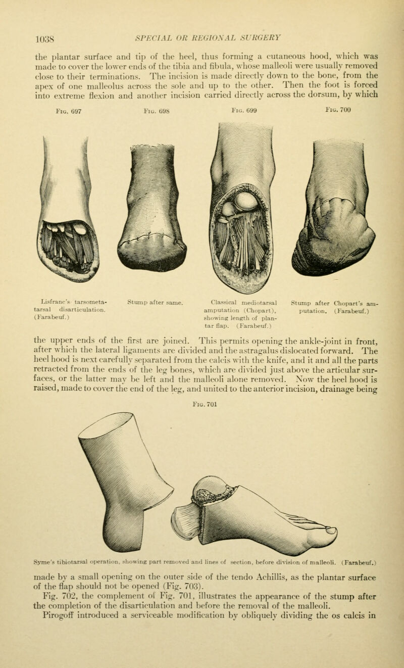 the {jlantar surface and tij) of the heel, thus forminrr a cutaneous hood, which was made to cover the lower ends of the tibia and fibula, whose malleoli were usually removed close to their terminations. The incision is made directly down to the bone, from the apex of one malleolus across the sole and up to the other. Then the foot is forced into extreme flexion and another incision carried directly across the dorsum, by which Fig, 697 I'm. t)9S Fig. 699 Fio. 700 Lisfranc's tarsometa- tarsal disarticulation. (Farabeuf.) Stump after same. Classical mediotarsal amputation (Chopart), showing length of plan- tar flap. (Farabeuf.) Stump after Chopart's am- putation. (Farabeuf.) the upper ends of the first are joined. This permits openincr the ankle-joint in front, after which the lateral ligaments are divided and the astragalus dislocated forward. The heel hood is nexl carefully .separated from the calcis with the knife, and it and all the parts retracted from the ends of the leg bones, which are divided just above the articular sur- faces, or the latter may be left and the malleoli alone removed. Now the lieel hood is raised, made to cover the end of the leg, and united to the anterior incision, drainage being Fig. 701 Syme's tibiotarsal oi>eration, showing part removed and lines of section, before di\-i.-ifin of malleoli. ( Farabeuf.) made by a small opening on the outer side of the tendo Achillis, as the plantar surface of the flap should not be opened (Fig. 703). Fig. 702, the complement o{ Fig. 701, illustrates the appearance of the stump after the completion of the disarticulation and before the removal of the malleoli. Pirogoff introduced a serviceable modification by obliquely dividing the os calcis in