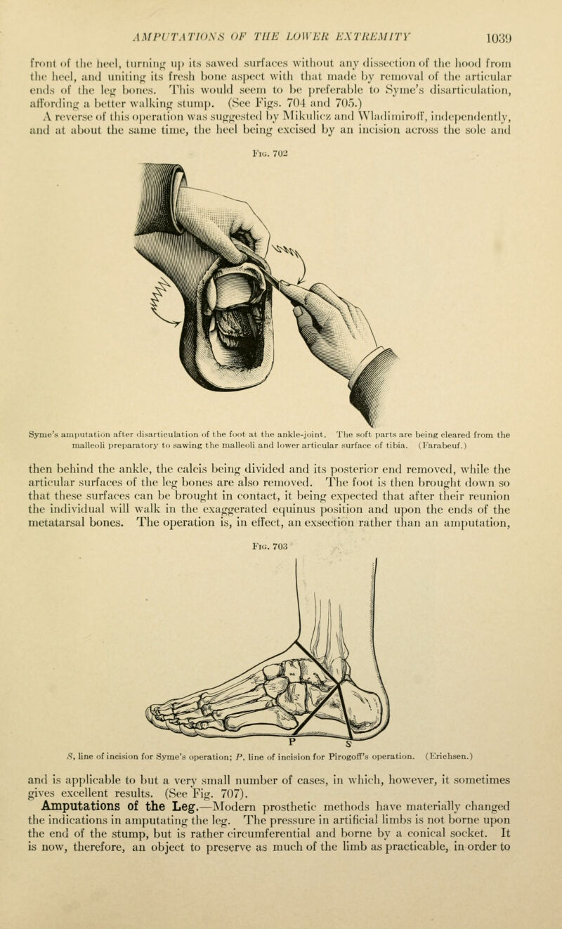 front (if \\\v Ik'1'1, tiirnin<^ ii|) its sawed surfarcs without any dissection of the liood from the heel, and unititio; its fr(>sh hone aspect with that made by removal of the articuhir ends of the le<,f l)ones. Tiiis would seem to he preferable to Symc's disarticulation, affordini; a better walkino; stumj). (See Fiijs. 704 and 705.) A reverse of this operation was sufjfjjested by Mikulicz and Wladimirolf, independently, and at about the same time, the heel being excised by an incision across the sole and Fig. 701' Syme's amputation after disarticulation of the foot at the ankle-joint. The soft parts are being cleared from the malleoli preparatory to sawing the malleoli and lower articular surface of tibia. (Farabeuf.) then behind the ankle, the calcis being divided and its posterior end removed, while the articular surfaces of the leg bones are also removed. The foot is then brought down so that these surfaces can be brought in contact, it being expected that after their reunion the individual will walk in the exaggerated equinus position and upon the ends of the metatarsal bones. The operation is, in effect, an exsection rather than an amputation, Fig. 703 P s- .9, line of incision for vSyme's operation; P, line of incision for Pirogoff's operation. (Erichsen.) and is applicable to but a very small number of cases, in which, however, it sometimes gives excellent results. (See Fig. 707). Amputations of the Leg.—IModern prosthetic methods have materially changed the indications in amputating the leg. The pressure in artificial limbs is not borne upon the end of the stump, but is rather circumferential and borne by a conical socket. It is now, therefore, an object to preserve as much of the limb as practicable, in order to