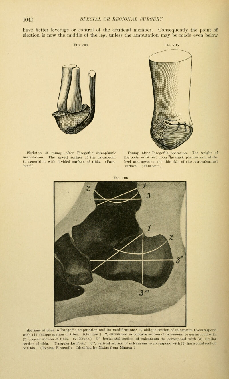 have better levera<jc or control of the artificial nicinbcr. (Consequently the point of election is now the middle of the leg, unless the amputation may be made even below I'lu. 704 Fig. 705 Skeleton of stump after PirogofF's osteoplastic amputation. The sawed surface of the calcaneum in apposition with divided surface of tibia. (Fara- beuf.) Stump after Pirogoff's operation. The weight of the body must rest upon ttie tliick plantar skin of the heel and never on the thin skin of the retrocalcaneal surface. (Farabeuf.) Fig 706 Sections of bone in Pirogoff's amputation and its modifications: 1, oblique section of calcaneum to correspond with (1) oblique section of tibia. (Gunther.) 2, curvilinear or concave section of calcaneum to correspond with (2) convex section of tibia, (v. Bruns.) 3, horizontal section of calcaneum to correspond with (3) similar section of tibia. (Pasquier Le Fort.) 3', vertical section of calcaneum to correspond with (3) horizontal section of tibia. (Typical Pirogoff.) (Modified by Matas from Mignon.)