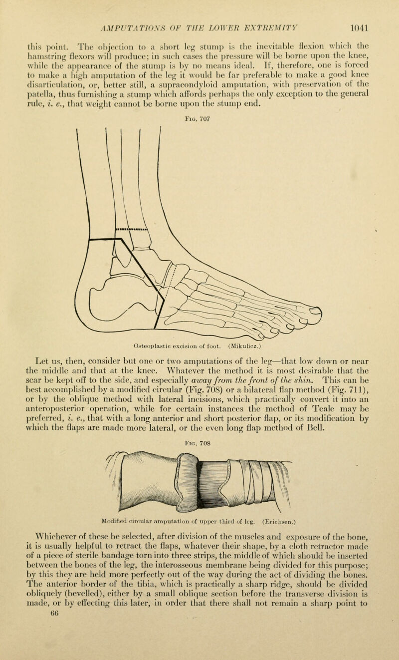 this point. Tlir ohjcction to a short Ic^ stuiii|) is the iiifvitahU' flexion wliicii the hanis(rini>; flrxors will produce; in such cases the ])ressurc will he borne upon the knee, while the appearance of the stuinj) is by no means ideal. If, therefore, one is forced to make a hi<;h umputation of the leg it would be far preferable to make a good knee disarticulation, or, j)etter still, a supracondyloid amputation, with preservation of the patella, thus furnishing a stump which affords j)erhaps the only exception to the general rule, i. c, that wiMght cannot be borne upon the stum}) end. Fig. 707 Osteoplastic excision of foot. (Mikulicz.) Let us, then, consider but one or two amputations of the leg—that low down or near the middle and that at the knee. Whatever the method it is most desirable that the scar be kept off to the side, and especially away from ihe front of the shin. This can be best accomplished by a modified circular (Fig. 708) or a bilateral flap method (Fig. 711), or by the oblique method with lateral incisions, which practically convert it into an anteroposterior operation, while for certain instances the method of Teale may be preferred, i. e., that with a long anterior and short posterior flap, or its modification by which the flaps are made more lateral, or the even long flap method of Bell. Fig. 708 Modified circular amputation of upper third of leg. (Ericlisen.) Whichever of these be selected, after division of the muscles and exposure of the bone, it is usually helpful to retract the flaps, whatever their shape, by a cloth retractor made of a piece of sterile bandage torn into three strips, the middle of which should be inserted between the bones of the leg, the interosseous membrane being divided for this purpose; by this they are held more perfectly out of the way during the act of dividing the bones. The anterior border of the tibia, which is practically a sharp ridge, should be divided obliquely (bevelled), either by a small oblique section before the transverse division is made, or by effecting this later, in order that there shall not remain a sharp point to 66