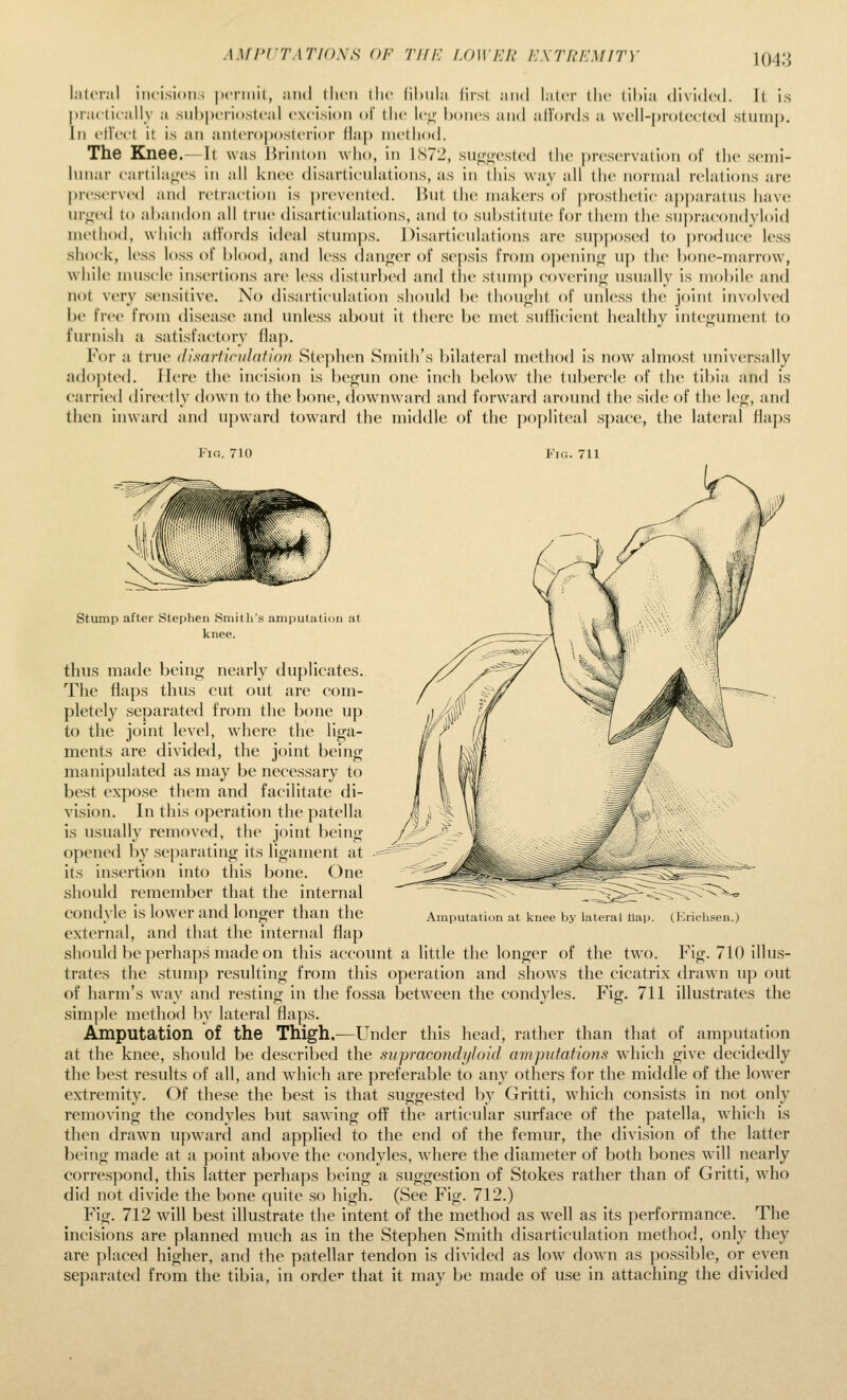 l;it('r;il incision.-; |K'riiiit, and (lien llic lihula lirsl and later tlic lihia divided. It is |trac(ii'all_v a .snl)|>i'ri(>.steal excision of tlu' lei;- hones and all'ords a well-prolccted .stump. In ellecl it is an anten)|)osleri()r flap method. The Knee.- It was Hrinton who, in 1S72, suo;oested tlie j)reservuti()ii of the semi- hmar carlila;;('s in all knee disarticuhitions, as in this way all the normal relations arc preserved and retraction is prevented. But the makers of jirosthetic apparatus have m-^'cd to ahandon all true disarticulations, and to substitute for them the su|)racondyloid method, which affords ideal stumps. Disarticulations are supposed to produce less shock, less loss of blood, and less danoer of sepsis from openintf uj) the bone-marrow, while nuiscle insertions are less disturbed and tlie stump covering; usually is mobile and not very sensitive. No disarticulation should be thou<>ht of unless the joint involved be free from disea.se and unless about it (here I)e met suflicient healthy inte<!;ument to furnish a satisfactory flap. For a true (ILs-articiilation Stephen Smith's bilateral method Is no\v almost universally a(lo])te(l. Here the incision is begun one inch below the tubercle of the tibia and is carried directly down to the bone, downward and forw^ard around the side of the leg, and then inward and upward toward the middle of the j)opliteal space, the lateral flaj)s Fici. 7U) Amputation at knee by lateral tlap. (Erichsen.) Stump after Stephen .Smith's amputatiun at knee. thus made being nearly duplicates. The flaps thus cut out are com- pletely separated from the bone up to the joint level, where the liga- ments are divided, the joint being manipulated as may be necessary to best expose them and facilitate di- vision. In this operation the patella is usually removed, the joint being opened by separating its ligament at - its insertion into this bone. One should remember that the internal condyle is lower and longer than the external, and that the internal flap should be perhaps made on this account a little the longer of the two. Fig. 710 illus- trates the stump resulting from this operation and shows the cicatrix drawn up out of harm's way and resting in the fossa between the condyles. Fig. 711 illustrates the sim])le method by lateral flaps. Amputation of the Thigh.—Under this head, rather than that of amputation at the knee, should be described the supracondijloid amputations which give decidedly the best results of all, and which are preferable to any others for the middle of the lower extremity. Of these the best Is that suggested by Grlttl, wdiich consists in not only removing the condyles but saAvIng off the articular surface of the patella, which is then drawn upward and applied to the end of the femur, the division of the latter being made at a point above the condyles, where the diameter of both bones will nearly correspond, this latter perhaps being a suggestion of Stokes rather than of GrittI, wdio did not divide the bone quite so high. (See Fig. 712.) Fig. 712 wall best illustrate the intent of the method as well as its performance. The incisions are planned much as in the Stephen Smith disarticulation method, only they are placed higher, and the patellar tendon Is divided as low down as possible, or even separated from the tibia, in ordc that it may be made of use In attaching the divided