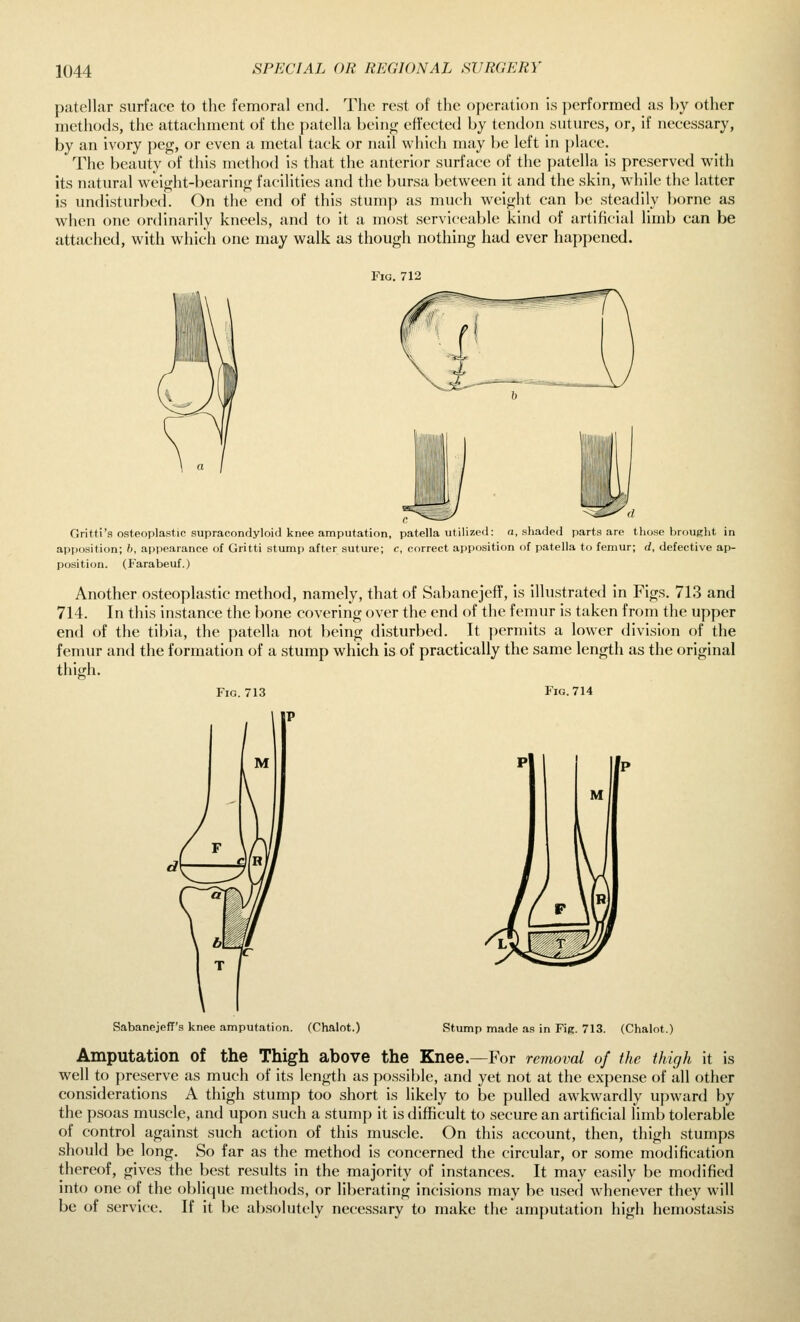 patellar surface to the femoral end. The rest of the operation is performed as by other methods, the attachment of the patella beini-; effected by tendon sutures, or, if necessary, by an ivory peg, or even a metal tack or nail which may be left in place. The beauty of this method is that the anterior surface of the patella is preserved with its natural wanght-bearino; facilities and the bursa between it and the skin, while the latter is undisturbed. On the end of this stump as much weight can be steadily borne as when one ordinarily kneels, and to it a most serviceable kind of artificial limb can be attached, with which one may walk as though nothing had ever happened. Fig. 712 Gritti's osteoplastic supracondyloid knee amputation, patella utilized: a, shaded parts are those brought in app(jsition; h, appearance of Gritti stump after suture; c, correct apposition of patella to femur; d, defective ap- position. (Farabeuf.) Another osteoplastic method, namely, that of Sabanejeff, is illustrated in Figs. 713 and 714. In this instance the bone covering over the end of the femur is taken from the upper end of the tibia, the patella not being disturbed. It permits a lower division of the femur and the formation of a stump which is of practically the same length as the original thiifh. Fig. 713 Fig. 714 Sabanejeff's knee amputation. (Chalot.) Stump made as in Fig. 713. (Chalot.) Amputation of the Thigh above the Knee.—For removal of the thigh it is well to preserve as much of its length as possible, and yet not at the expense of all other considerations A thigh stump too short is likely to be pulled awkwardly upward by the psoas muscle, and upon such a stump it is difficult to secure an artificial limb tolerable of control against such action of this muscle. On this account, then, thigh stumps should be long. So far as the method is concerned the circular, or some modification thereof, gives the best results in the majority of instances. It may easily be modified into one of the oblique methods, or liberating incisions may be used whenever they will be of service. If it be absolutely necessary to make the amputation high hemostasis