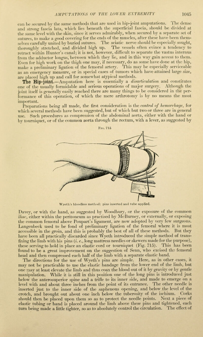 can l)o secured 1)V the saiiu methods that are used in hi|)-ji)iut amputations. The dense and strorif,' faseia hita, whieli lies beneath the superlieiai laseia, should he divided at the same level with the skin, since it serves admirably, when secured by a separate set of sutures, to make a <jood covering]; for the ends of the muscles, after these have been them- selves carefully united by buried sutures. The sciatic nerve should be especially sou>;ht, thorou«;hly stretched, and divided hi^rh up. The vessels often evince a tendency to retract within Hunter's canal; it is not, however, difficult to separate the vastus internus from tlie adductor lon«jus, between wdiich they lie, and in this way gain access to them. Kven for hiuh work on the thiii;li one may, if necessary, do as some have done at the hij), make a ])reliminary ligation of the femoral artery. This may be especially serviceable as an enuT<'-ency measure, or in special cases of tumors which have attained large size, are placed Iiigh uj) and call for somewhat aty})ical methods. Tne Hip-30int.—Amputation here is essentially a dimriiculation and constitutes one of the usually formidable and serious operations of major surgery. Although the joint itself is generally easily reached there are many things to be considered in the {)er- formance of this operation, of which the mere arthrotomy is by no means the most important. I'reparations being all made, the first consideration is the control of hemorrhage, for which several methods have been suggested, but of which but two or three are in general use. Such procedures as compression of the abdominal aorta, either w^ith the hand or by tourniquet, or of tlie common aorta through the rectum, with a lever, as suggested by Fig. 715 Wyeth's bloodless method: pins inserted and tube applied. Davey, or with the hand, as suggested by Woodbury, or the exposure of the common iliac, either within the peritoneum as practised by McBurney, or externally, or exposing the common femoral above Poupart's ligament, are now adopted by very few surgeons. Langenbeck used to be fond of preliminary ligation of the femoral where it is most accessible in the groin, and this is probably the best of all of these methods. But they have been all practically discarded since Wyeth introduced the simple method of trans- fixing the limb with his pins (i. e., long mattress needles or skewers made for the purpose), these serving to hold in place an elastic cord or tourniquet (Fig. 715). This has been found to be a great improvement on the suggestion of Senn, who excised the femoral head and then compressed each half of the limb with a separate elastic band. The directions for the use of Wyeth's pins are simple. Here, as in other cases, it may not be practicable to use the elastic bandage from the lower end of the limb, but one may at least elevate the limb and thus coax the blood out of it by gravity or by gentle manipulation. While it is still in this position one of the long pins is introduced just below the anterosuperior spine and a trifle to its inner side, and made to emerge on a level with and about three inches from the point of its entrance. The other needle is inserted just to the inner side of the saphenous opening, and below^ the level of the crotch, and brought out about one inch below the tuberosity of the ischium. Corks should then be placed upon them so as to protect the needle points. Next a piece of elastic tubing or band is placed around the limb above these pins and tightened, each turn being made a little tighter, so as to absolutely control the circulation. The effect of