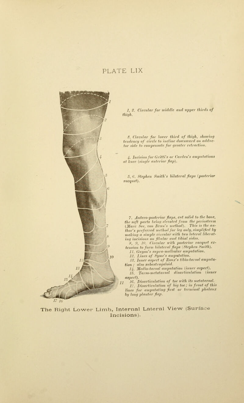 1, 2. Circular for middle and upper thirds of thigh. S. Circular for lower third of Ihiijh, fihowing tendency of circle to incline dounxvard on adduc- tor side to compensate for greater retraction. 4. Incision for (iriitVs or Garden's amputations at knee (single anterior flap). 5,6. Stephen Smith's bilateral flaps (posterior racquet). 7. Antero-posterior flaps, cut solid (0 the bone, the soft parts being elevated from the periosteum (Marc See, von Brun's method). This is the au- thor's preferred method for leg only, simplified by making a simple circular vith two lateral liberat- ing incisions on fibular and tibial sides. S, 0, 10. Circular vith posterior racquet ex- tension to form bilaterfd flaps {Stephen Smith). 11. Gnyon's supra-malleolar amputation. 12. Lines of Syme's amputation. IS. Inner aspect of lioux's tibio-tarsal amputa- tion ; also sub(istrag(doid. 14. Medio-tnrsal amputation (inner aspect). 15. Tavso-metatarsal disarticulation {inner aspect). 21 16. Disarticulation of toe with its metatarsal. 17. Disarticulation of big toe; in front of this lines for amputnting first or terminal phalanx by long jdantnr flap. The Right Lo^A^er Limb, Internal Lateral View (Surface Incisions).